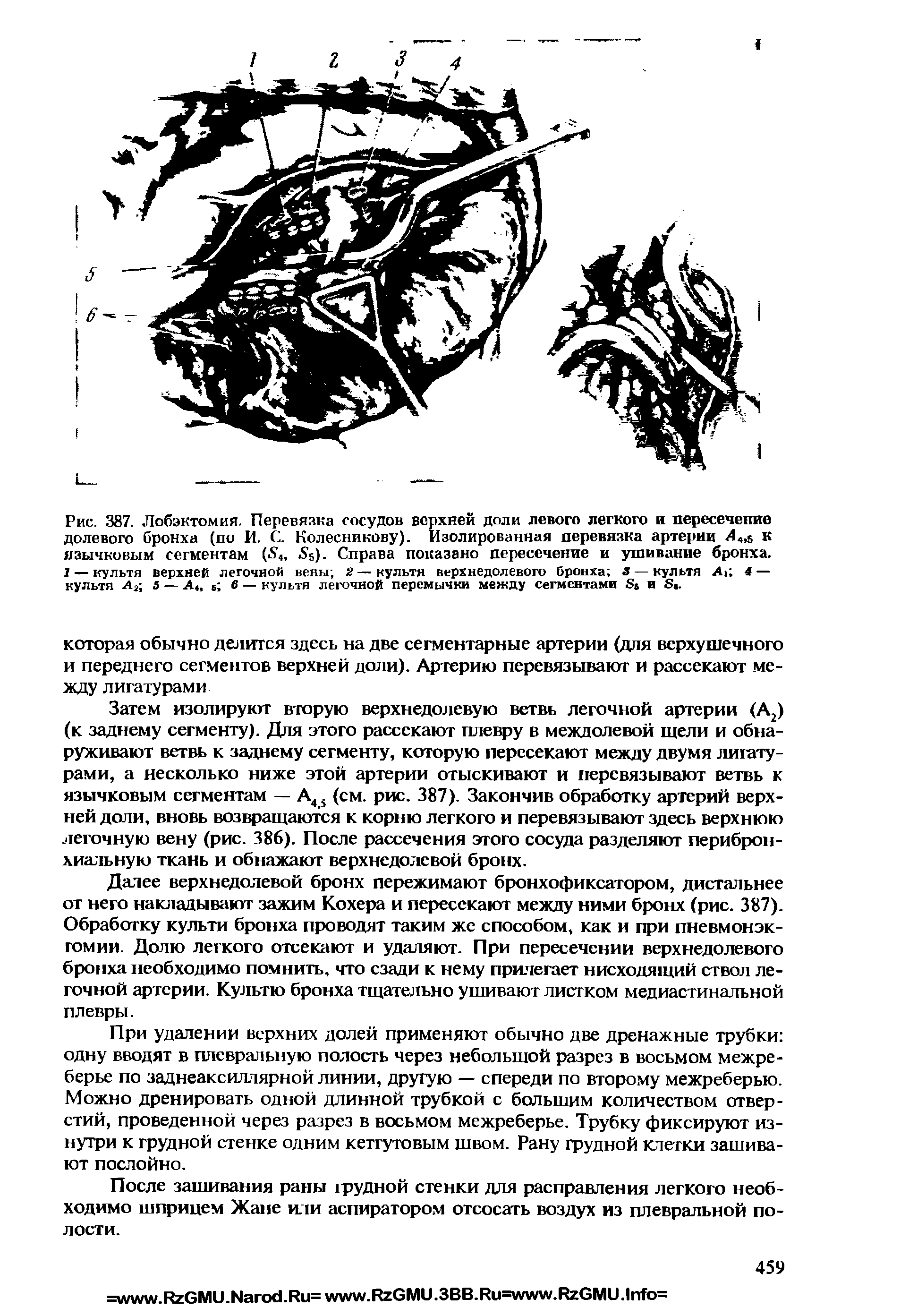 Рис. 387. Лобэктомия. Перевязка сосудов верхней доли левого легкого и пересечение долевого бронха (по И. С. Колесникову). Изолированная перевязка артерии к язычковым сегментам (Л, 5). Справа показано пересечение и ушивание бронха. 1 — культя верхней легочной вены 2 — культя верхнедолевого бронха 3 — культя А 4 — культя Аа 5 — А4, 6 6 — культя легочной перемычки между сегментами в и в .
