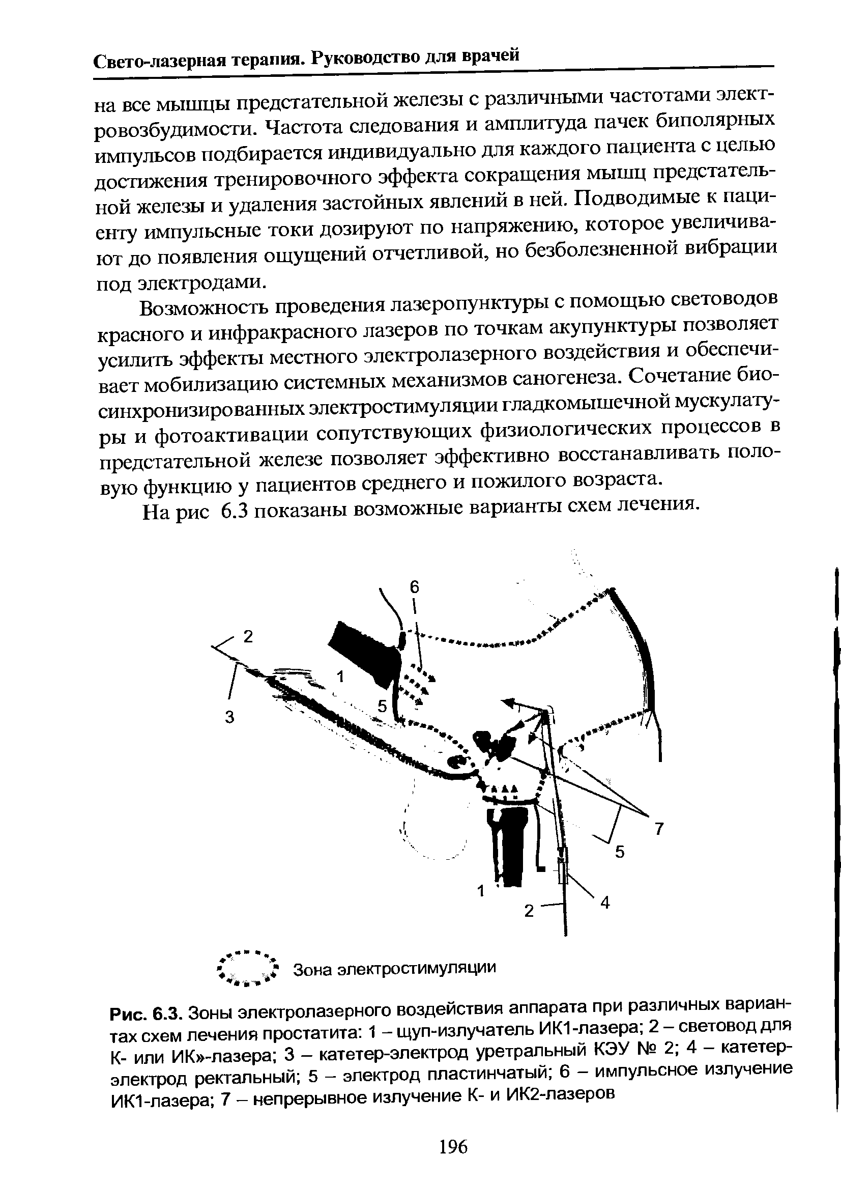 Рис. 6.3. Зоны электролазерного воздействия аппарата при различных вариантах схем лечения простатита 1 - щуп-излучатель ИК1-лазера 2 - световод для К- или ИК -лазера 3 - катетер-электрод уретральный КЭУ № 2 4 - катетер-электрод ректальный 5 - электрод пластинчатый 6 - импульсное излучение ИК1-лазера 7 - непрерывное излучение К- и ИК2-лазеров...