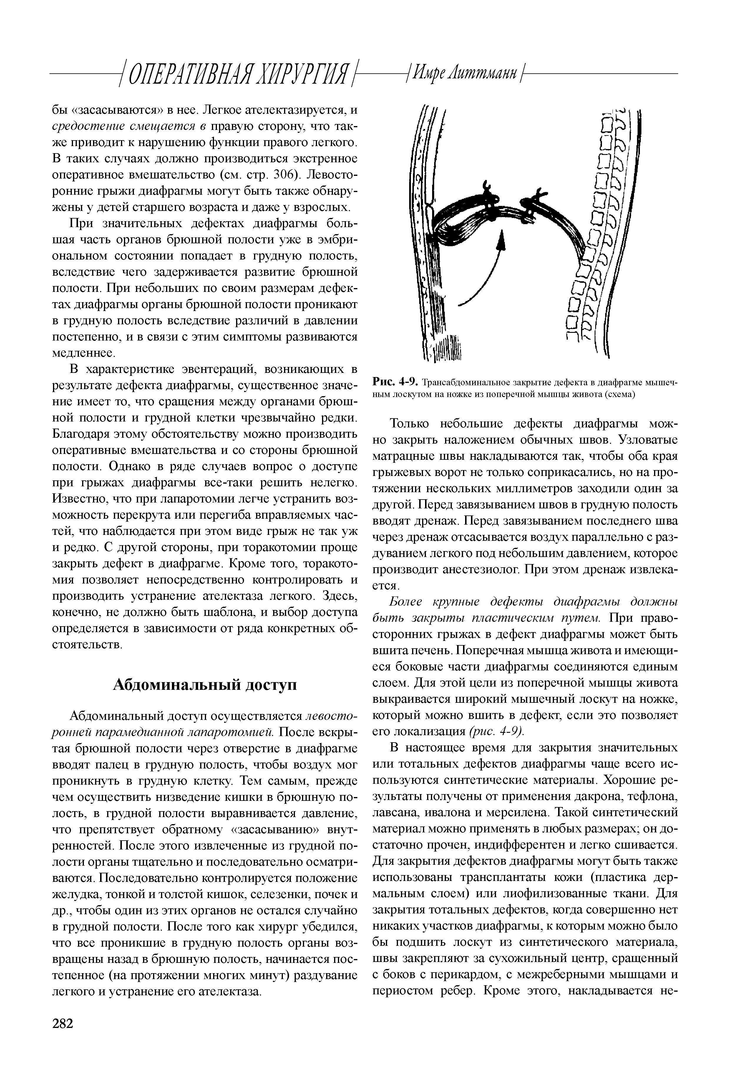 Рис. 4-9. Трансабдоминальное закрытие дефекта в диафрагме мышеч-ным лоскутом на ножке из поперечной мышцы живота (схема)...