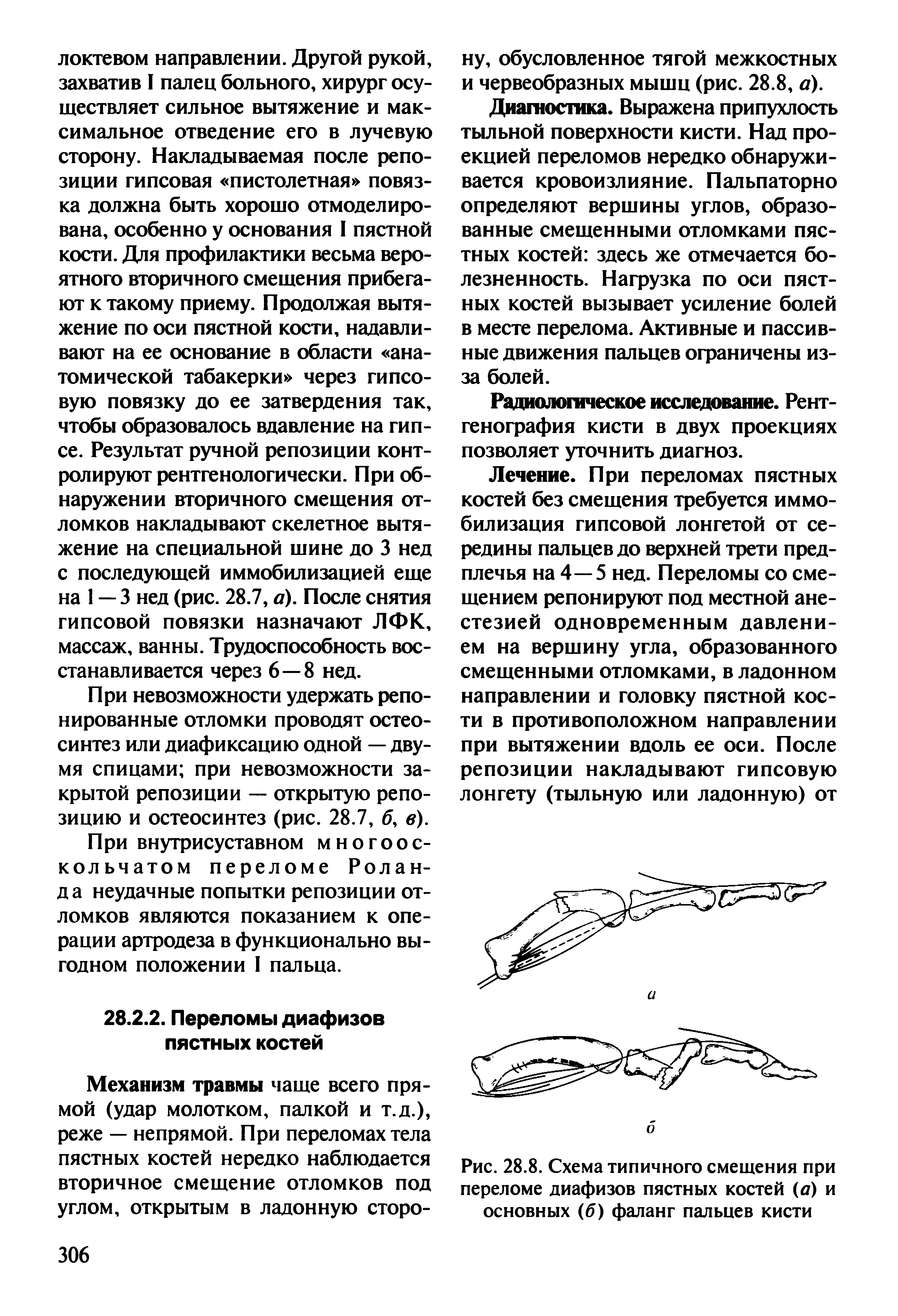 Рис. 28.8. Схема типичного смещения при переломе диафизов пястных костей (а) и основных (б) фаланг пальцев кисти...