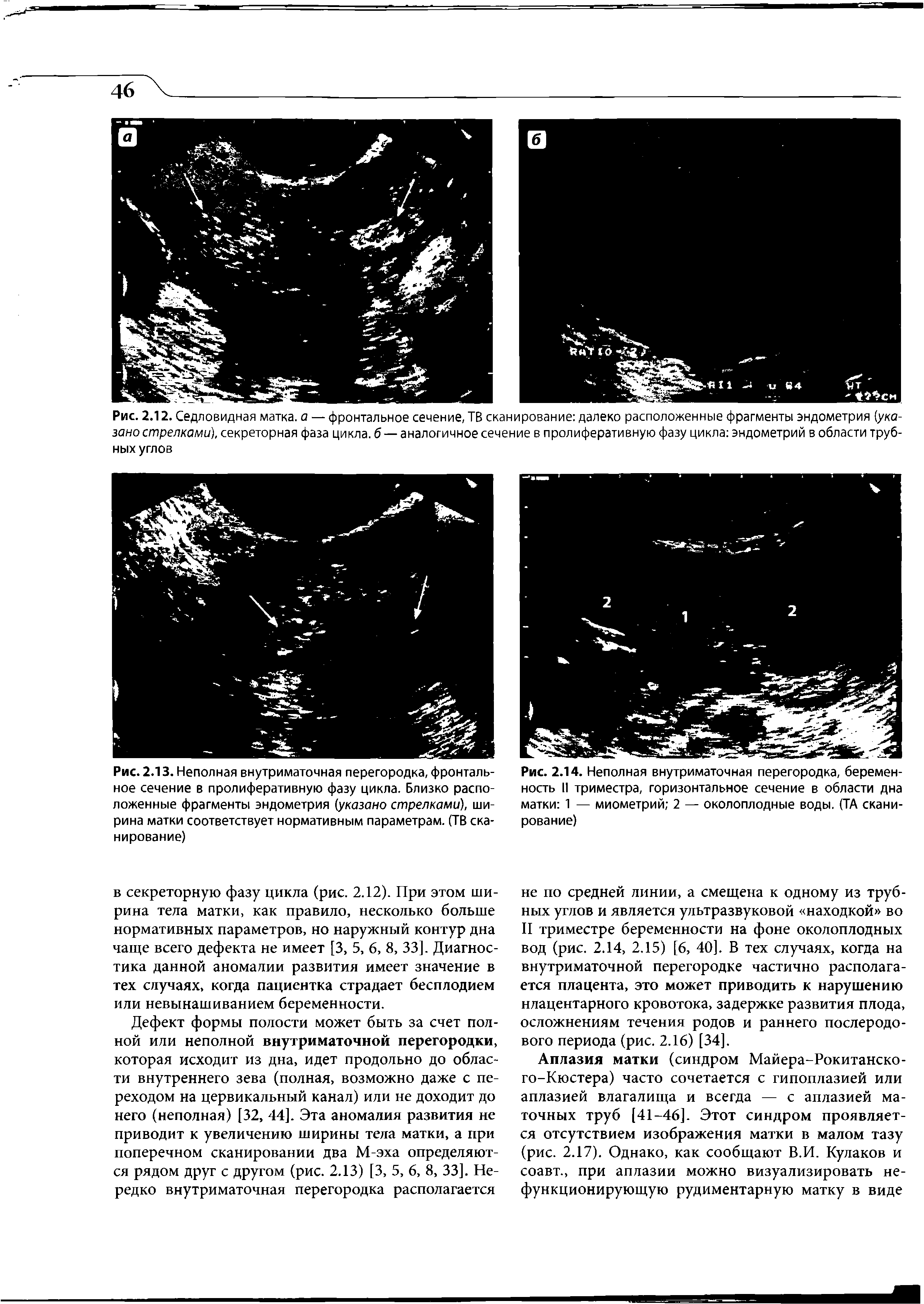 Рис. 2.14. Неполная внутриматочная перегородка, беременность II триместра, горизонтальное сечение в области дна матки 1 — миометрий 2 — околоплодные воды. (ТА сканирование)...