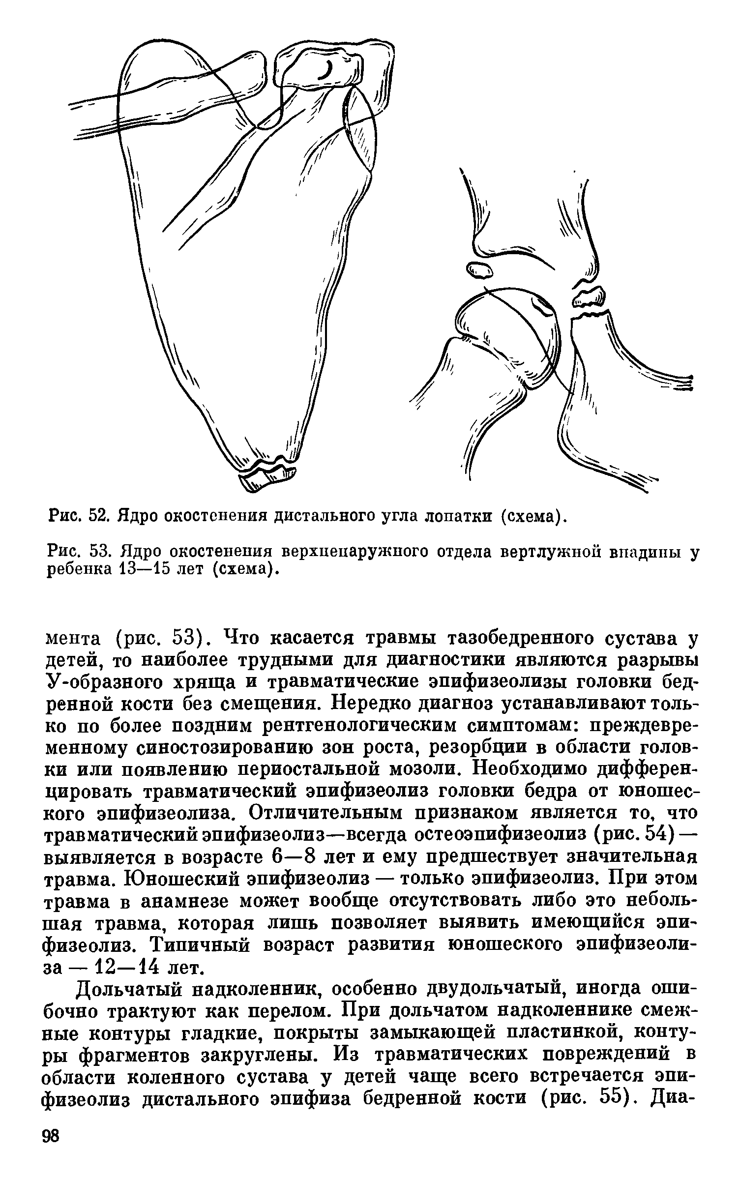 Рис. 53. Ядро окостенения верхненаружпого отдела вертлужной впадины у ребенка 13—15 лет (схема).