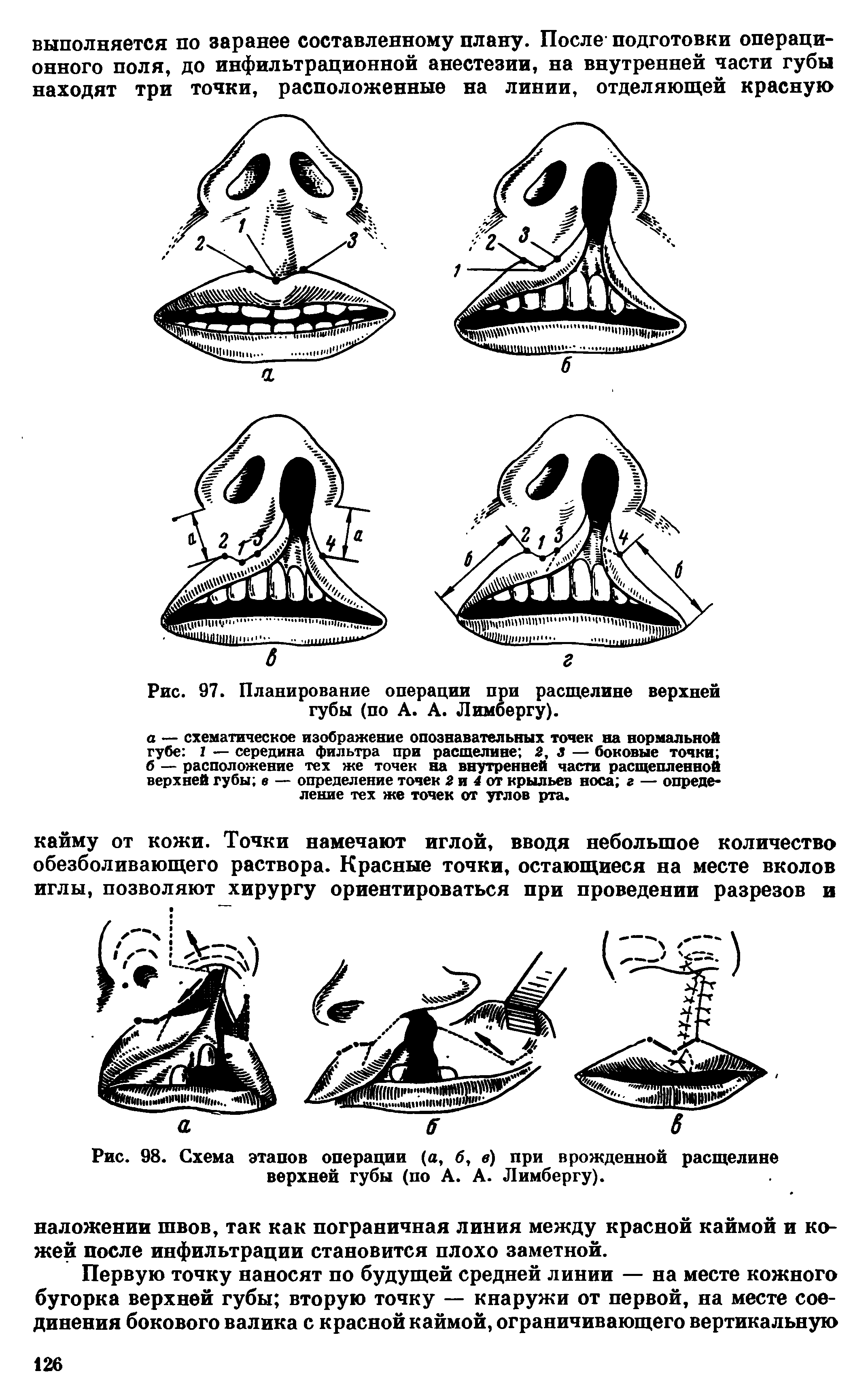Рис. 97. Планирование операции при расщелине верхней губы (по А. А. Лимбергу).
