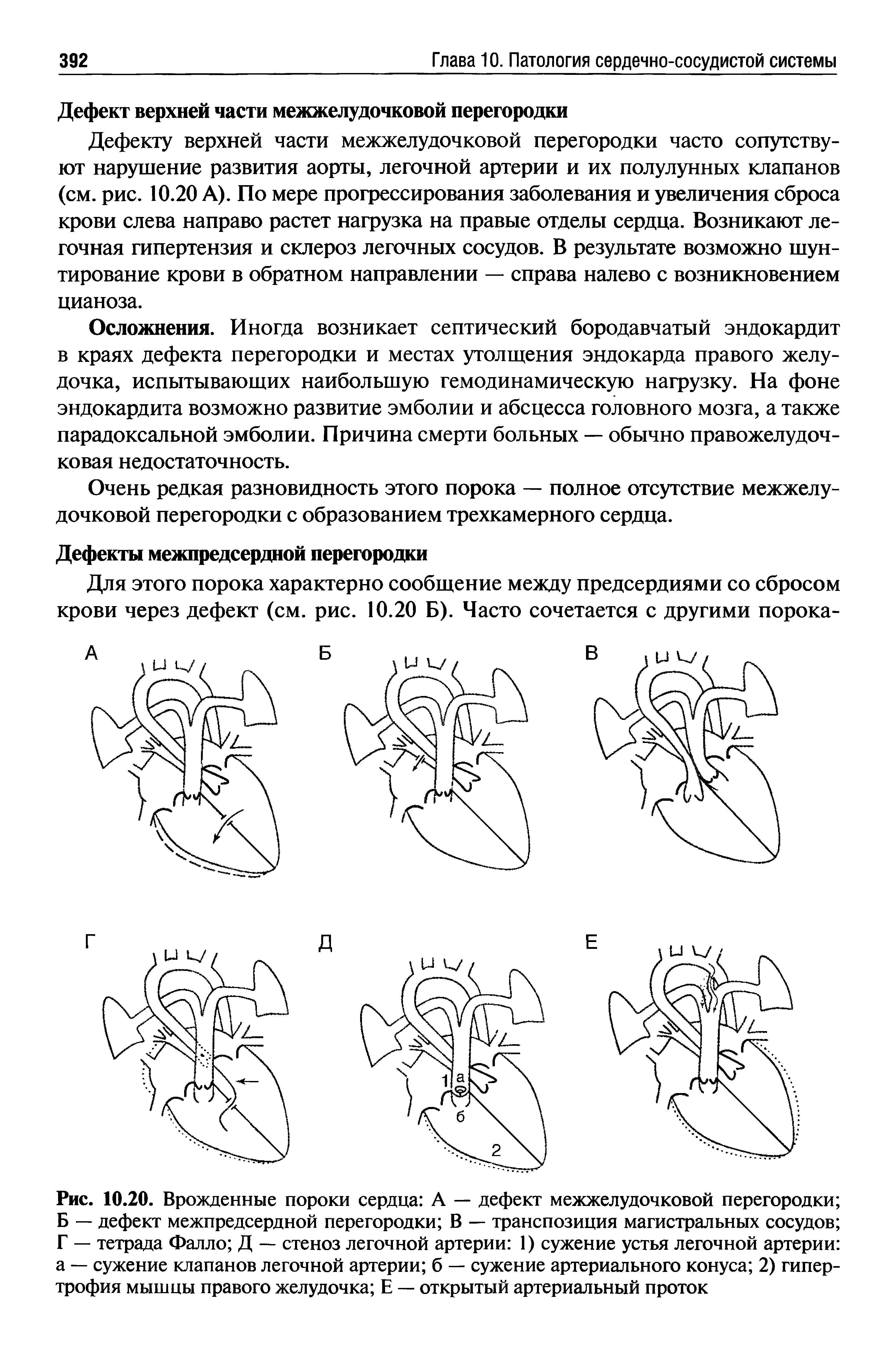 Рис. 10.20. Врожденные пороки сердца А — дефект межжелудочковой перегородки Б — дефект межпредсердной перегородки В — транспозиция магистральных сосудов Г — тетрада Фалло Д — стеноз легочной артерии 1) сужение устья легочной артерии а — сужение клапанов легочной артерии б — сужение артериального конуса 2) гипертрофия мышцы правого желудочка Е — открытый артериальный проток...