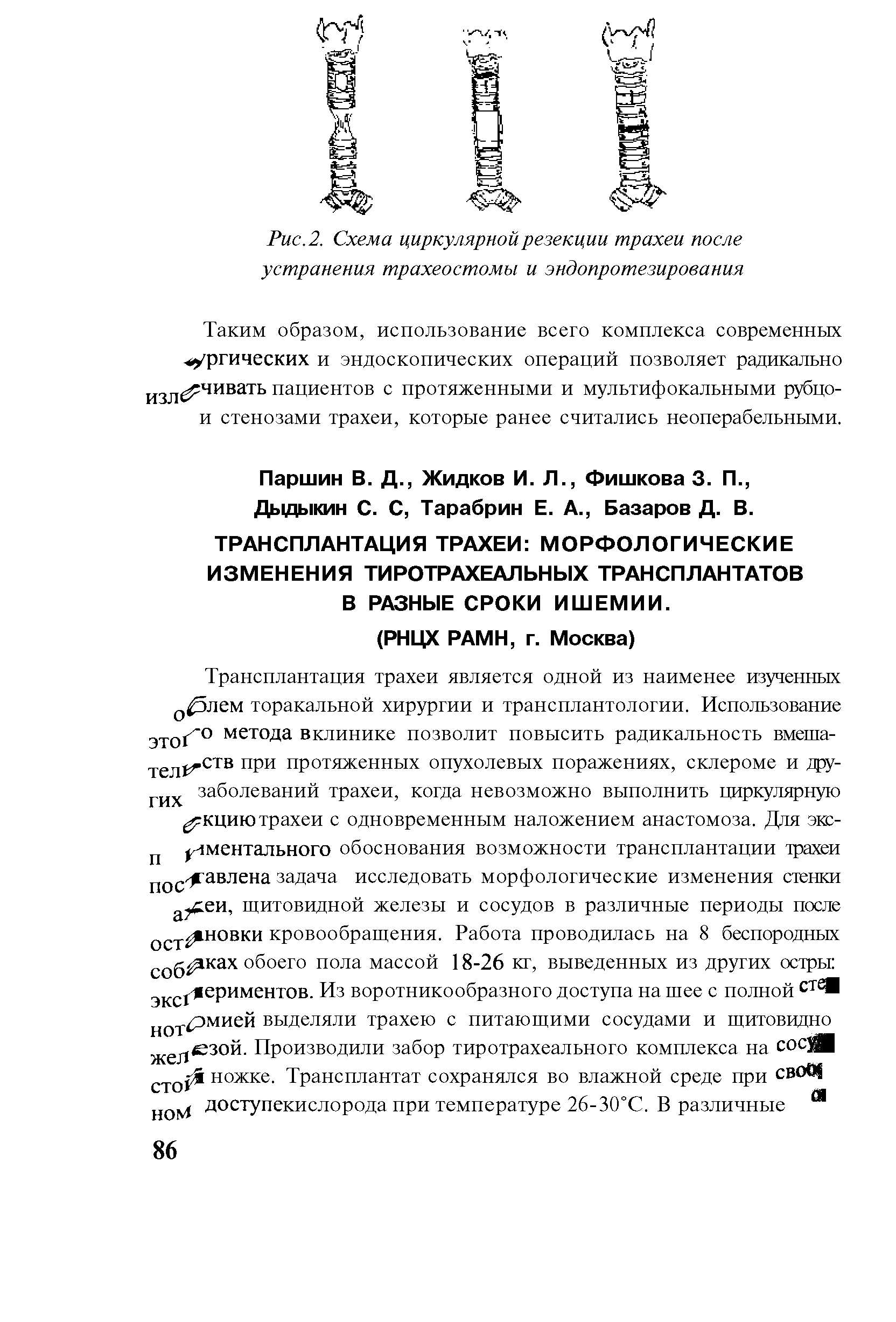 Рис. 2. Схема циркулярной резекции трахеи после устранения трахеостомы и эндопротезирования...