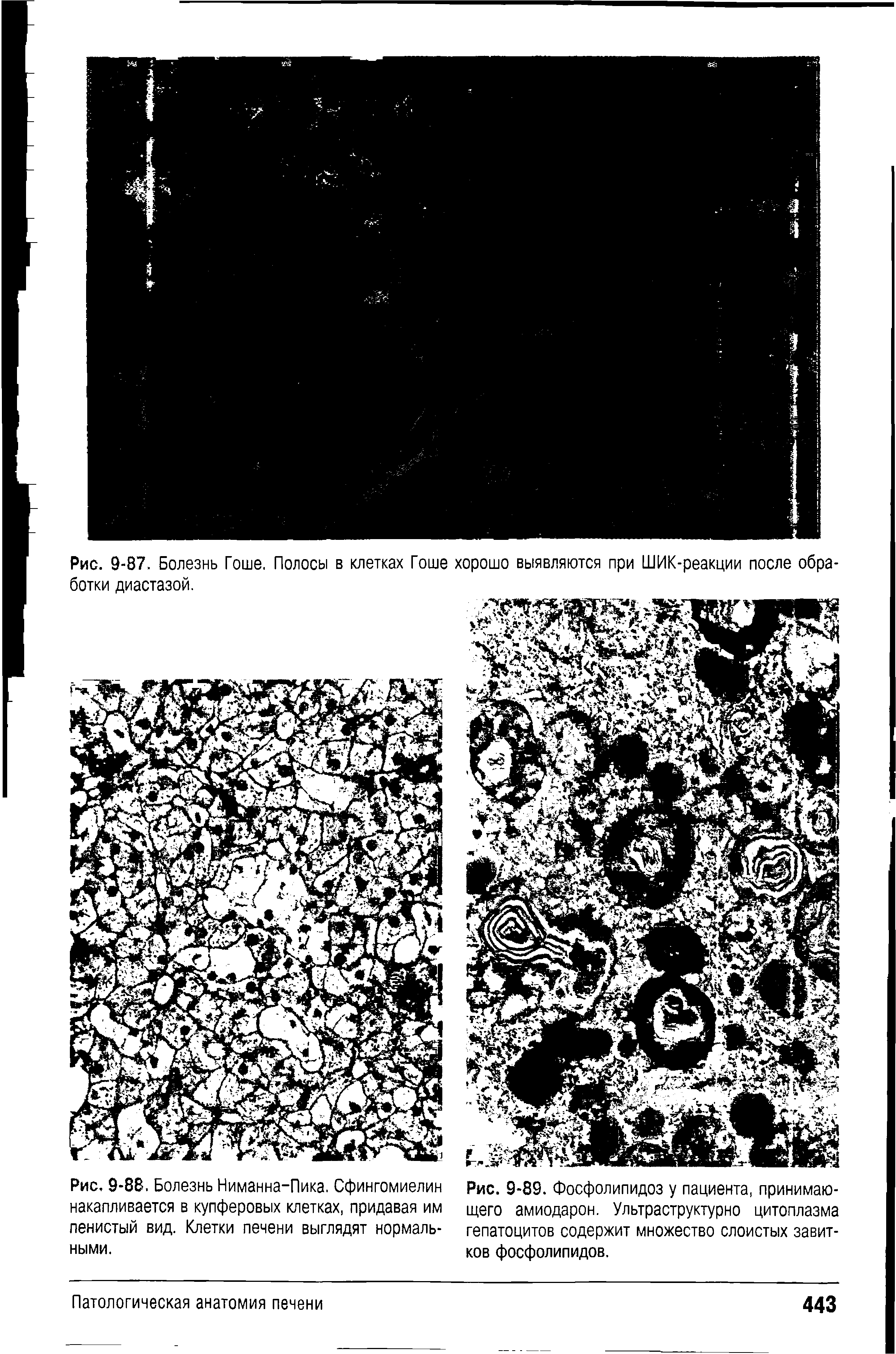 Рис. 9-88. Болезнь Ниманна-Пика. Сфингомиелин накапливается в купферовых клетках, придавая им пенистый вид. Клетки печени выглядят нормальными.