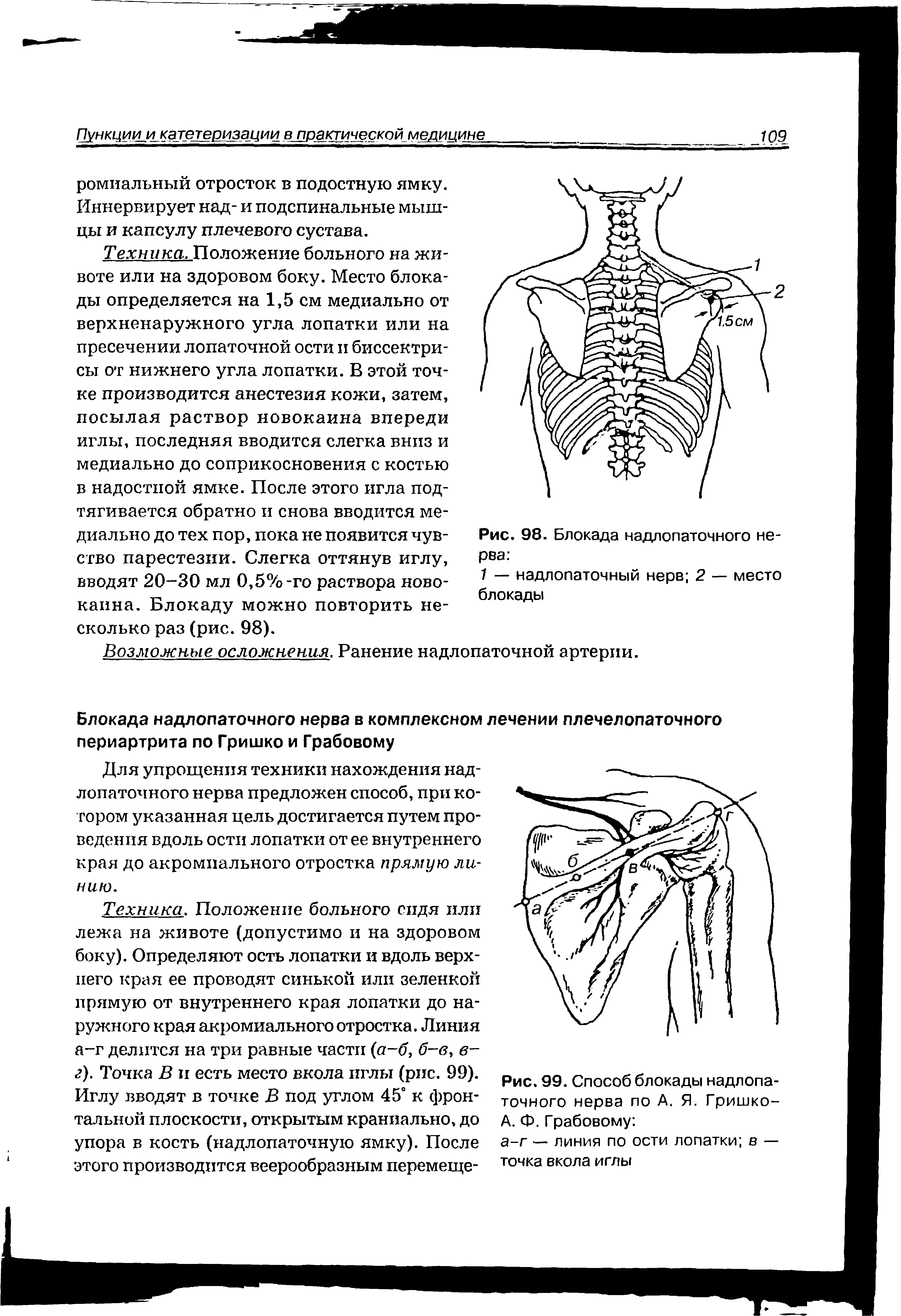 Рис. 99. Способ блокады надлопаточного нерва по А. Я. Гришко-А. Ф. Грабовому ...