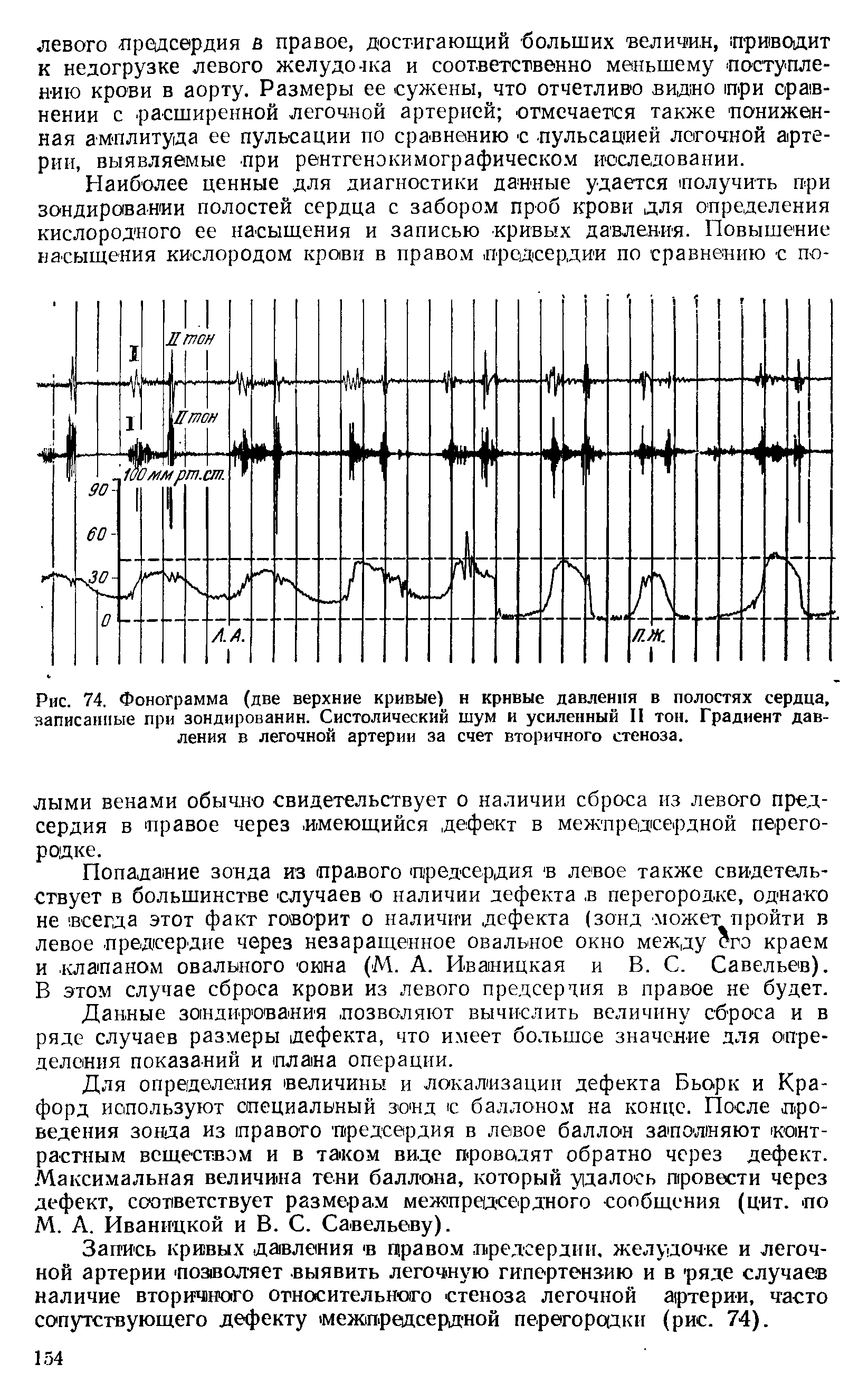 Рис. 74. Фонограмма (две верхние кривые) н кривые давления в полостях сердца, записанные при зондировании. Систолический шум и усиленный II тон. Градиент давления в легочной артерии за счет вторичного стеноза.