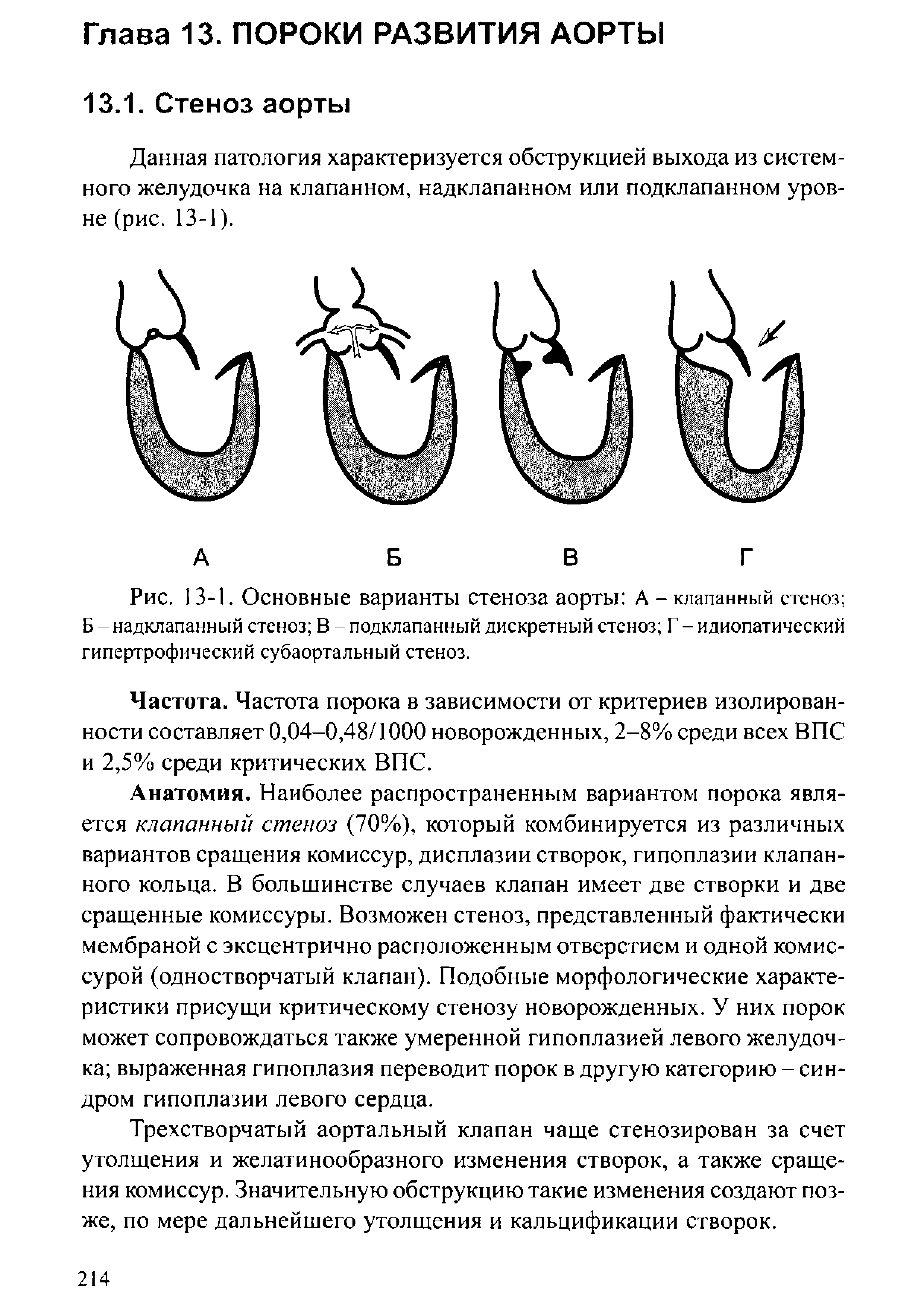 Рис. 13-1. Основные варианты стеноза аорты А-клапанный стеноз Б - надклапанный стеноз В - подклапанный дискретный стеноз Г - идиопатический гипертрофический субаортальный стеноз.