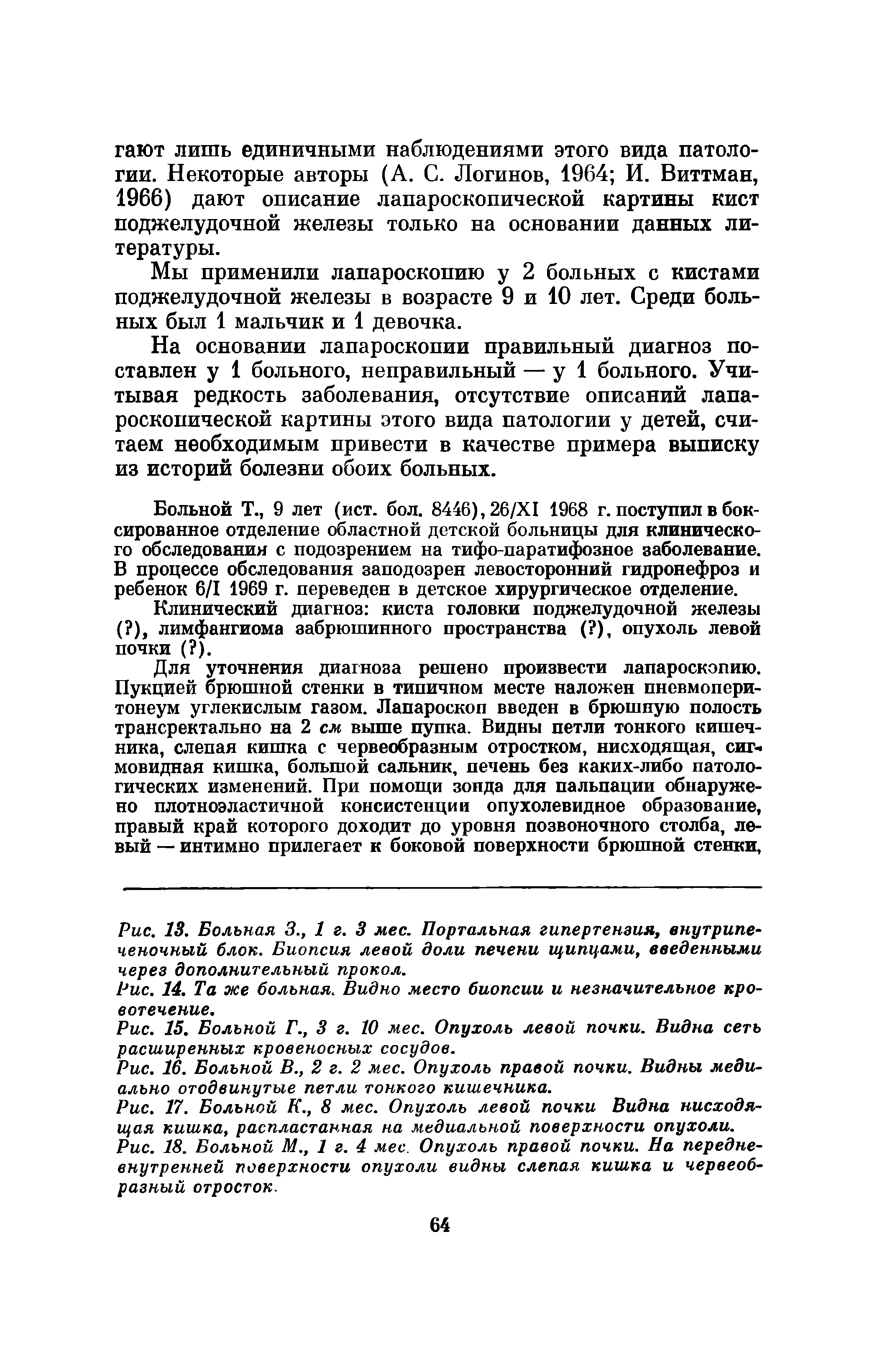 Рис. 18. Больной М., 1 г. 4 мес. Опухоль правой почки. На передневнутренней поверхности опухоли видны слепая кишка и червеобразный отросток.