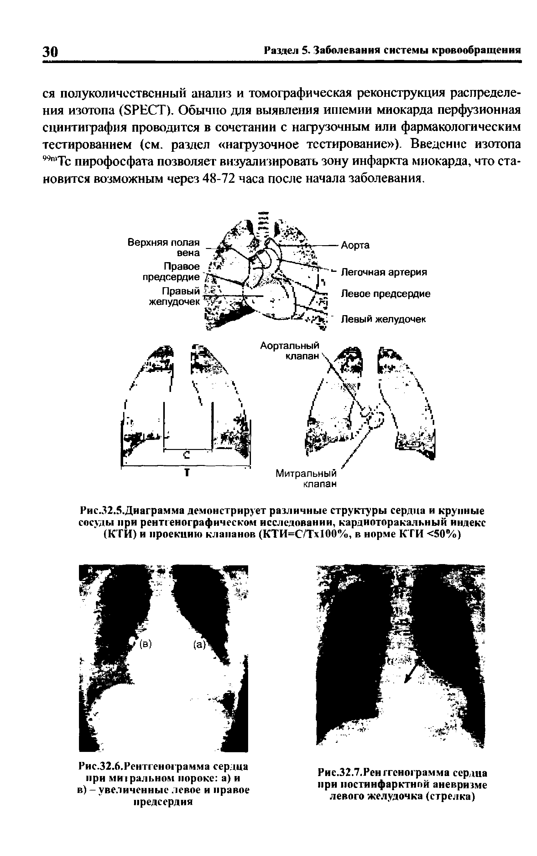 Рис.32.. Диаграмма демонстрирует различные структуры сердца и крупные сосуды при рентгенографическом исследовании, кардиоторакальный индекс (КТИ) и проекцию клапанов (КТИ=С/Тх100%, в норме КТИ <50%)...