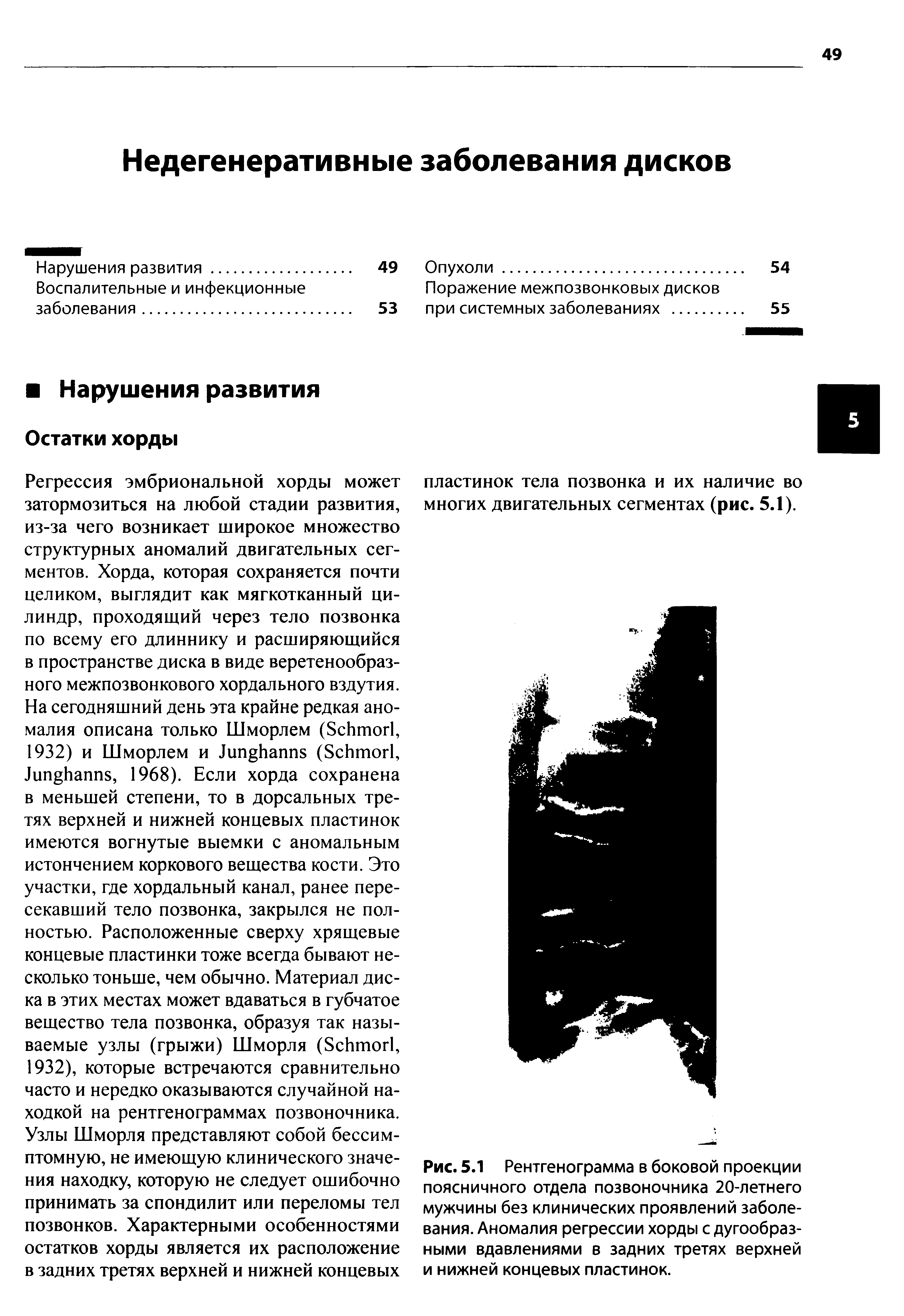 Рис. 5.1 Рентгенограмма в боковой проекции поясничного отдела позвоночника 20-летнего мужчины без клинических проявлений заболевания. Аномалия регрессии хорды с дугообразными вдавлениями в задних третях верхней и нижней концевых пластинок.