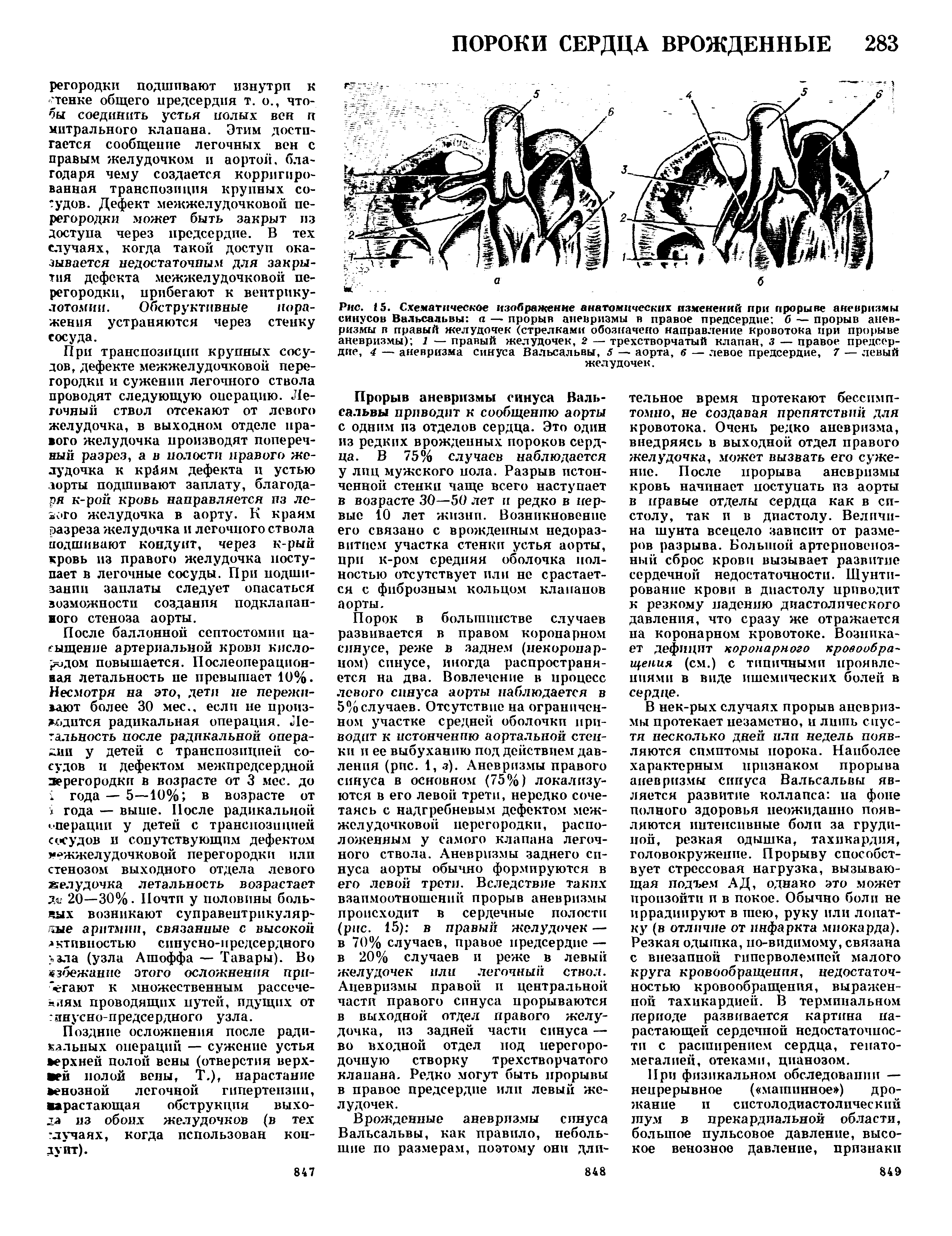 Рис. 15. Схематическое изображение анатомических изменений при прорыве аневризмы синусов Вальсальвы а — прорыв аневризмы в правое предсердие б — прорыв аневризмы в правый желудочек (стрелками обозначено направление кровотока при прорыве аневризмы) 7 — правый желудочек, 2 — трехстворчатый клапан, з — правое предсердие, 4 — аневризма синуса Вальсальвы, 5 — аорта, б — левое предсердие, 7 — левый желудочек.