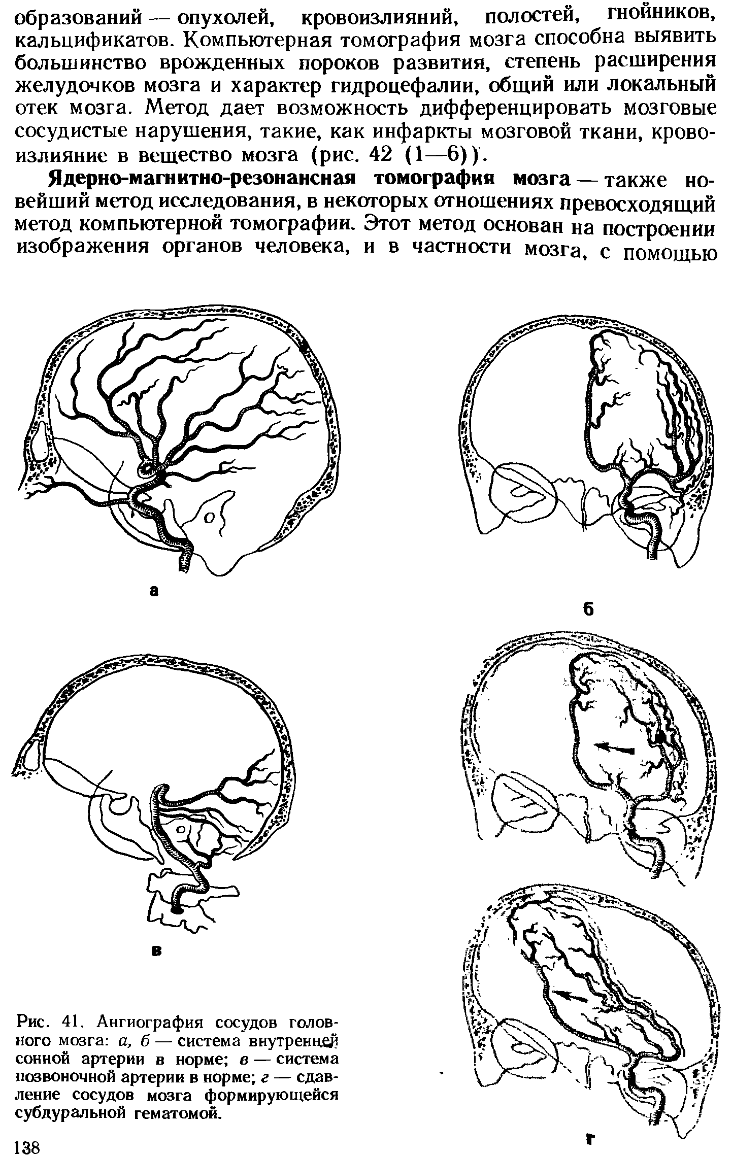 Рис. 41. Ангиография сосудов головного мозга а, б — система внутренней сонной артерии в норме в — система позвоночной артерии в норме г — сдавление сосудов мозга формирующейся субдуральной гематомой.