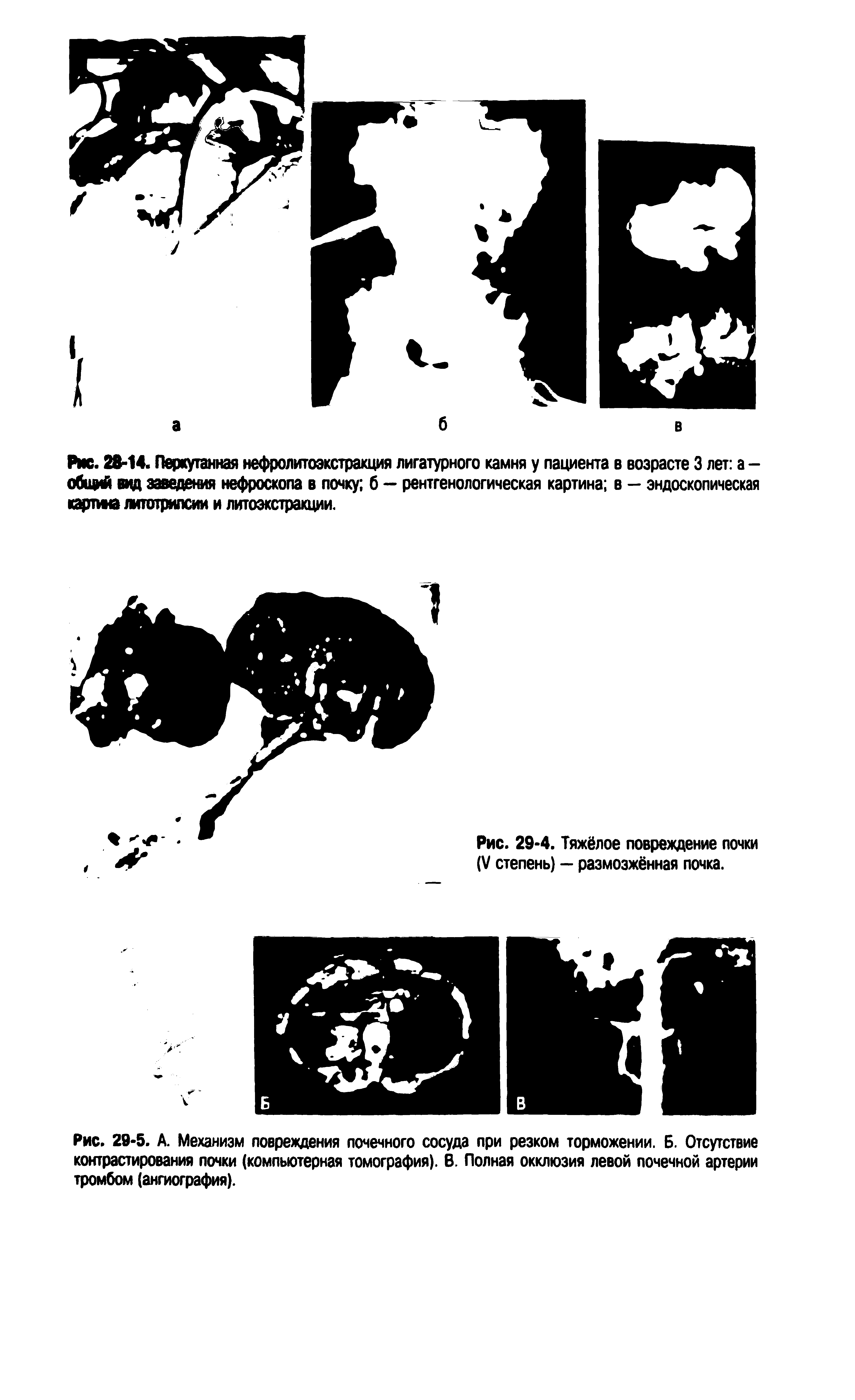 Рис. 29-5. А. Механизм повреждения почечного сосуда при резком торможении. Б. Отсутствие контрастирования почки (компьютерная томография). В. Полная окклюзия левой почечной артерии тромбом (ангиография).
