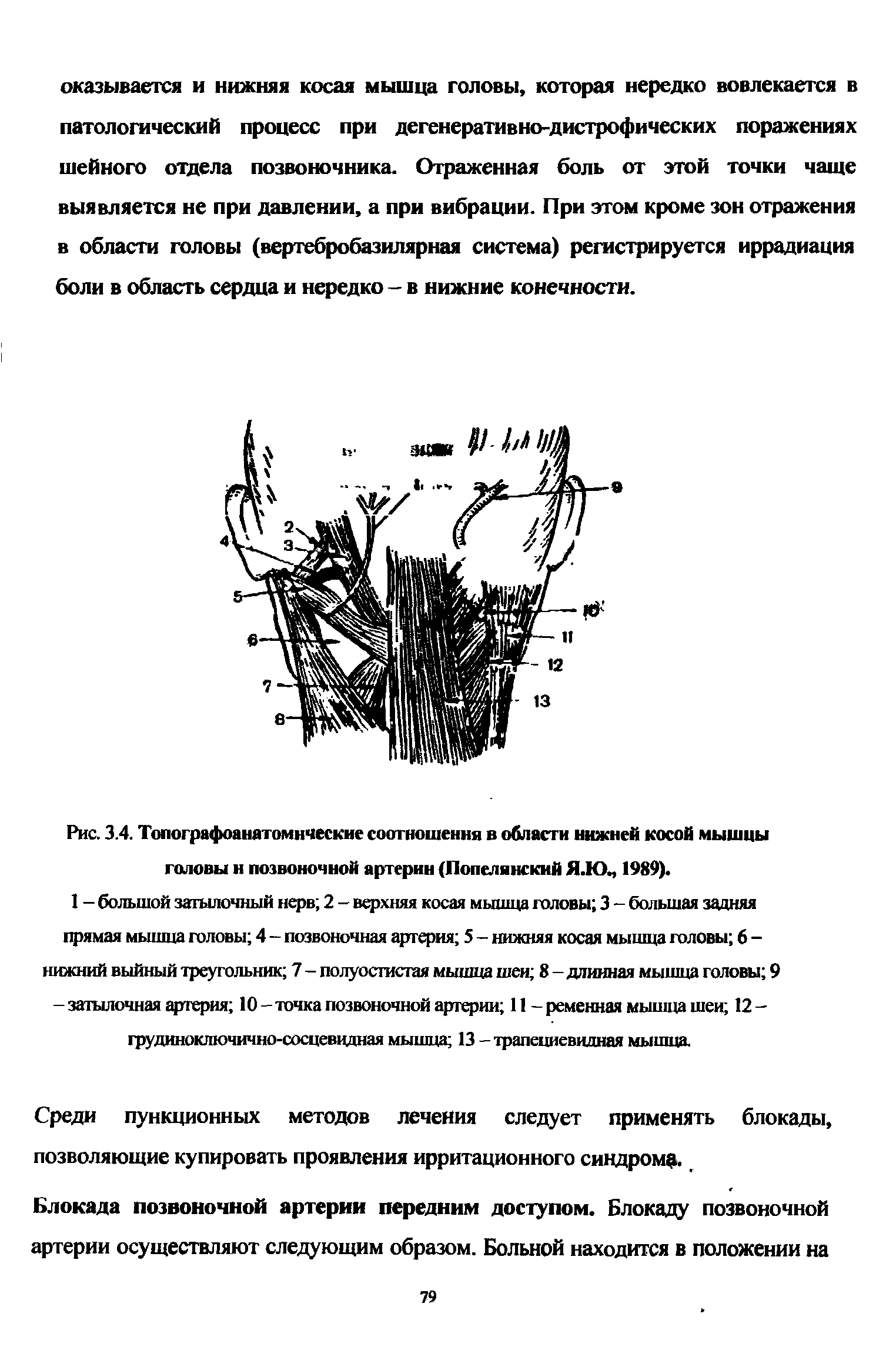 Рис. 3.4. Топографоанятомнческие соотношения в области нижней косой мышцы головы и позвоночной артерии (Попелянский Я.ЮЧ 1989).