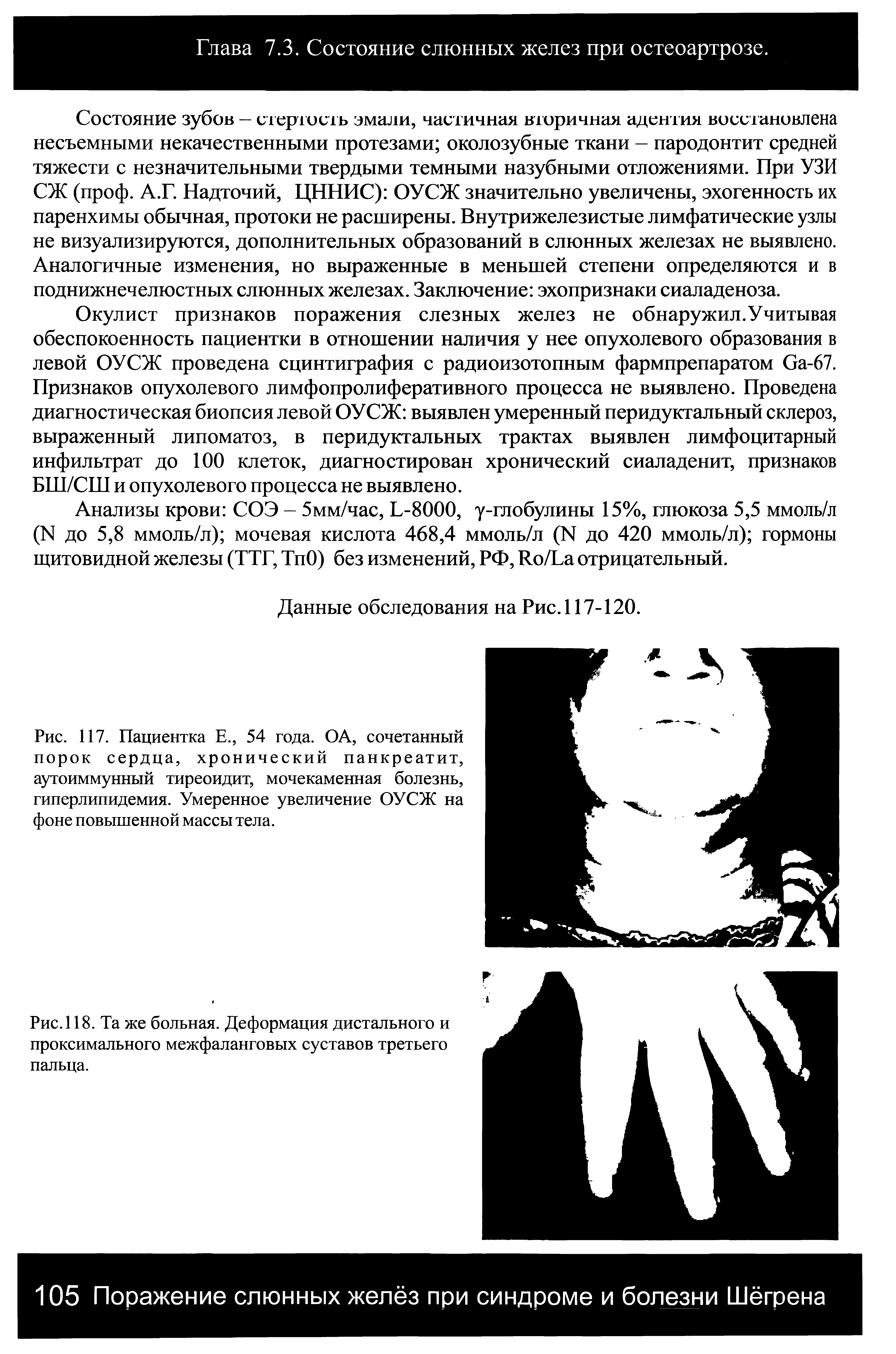 Рис. 117. Пациентка Е., 54 года. ОА, сочетанный порок сердца, хронический панкреатит, аутоиммунный тиреоидит, мочекаменная болезнь, гиперлипидемия. Умеренное увеличение ОУСЖ на фоне повышенной массы тела.