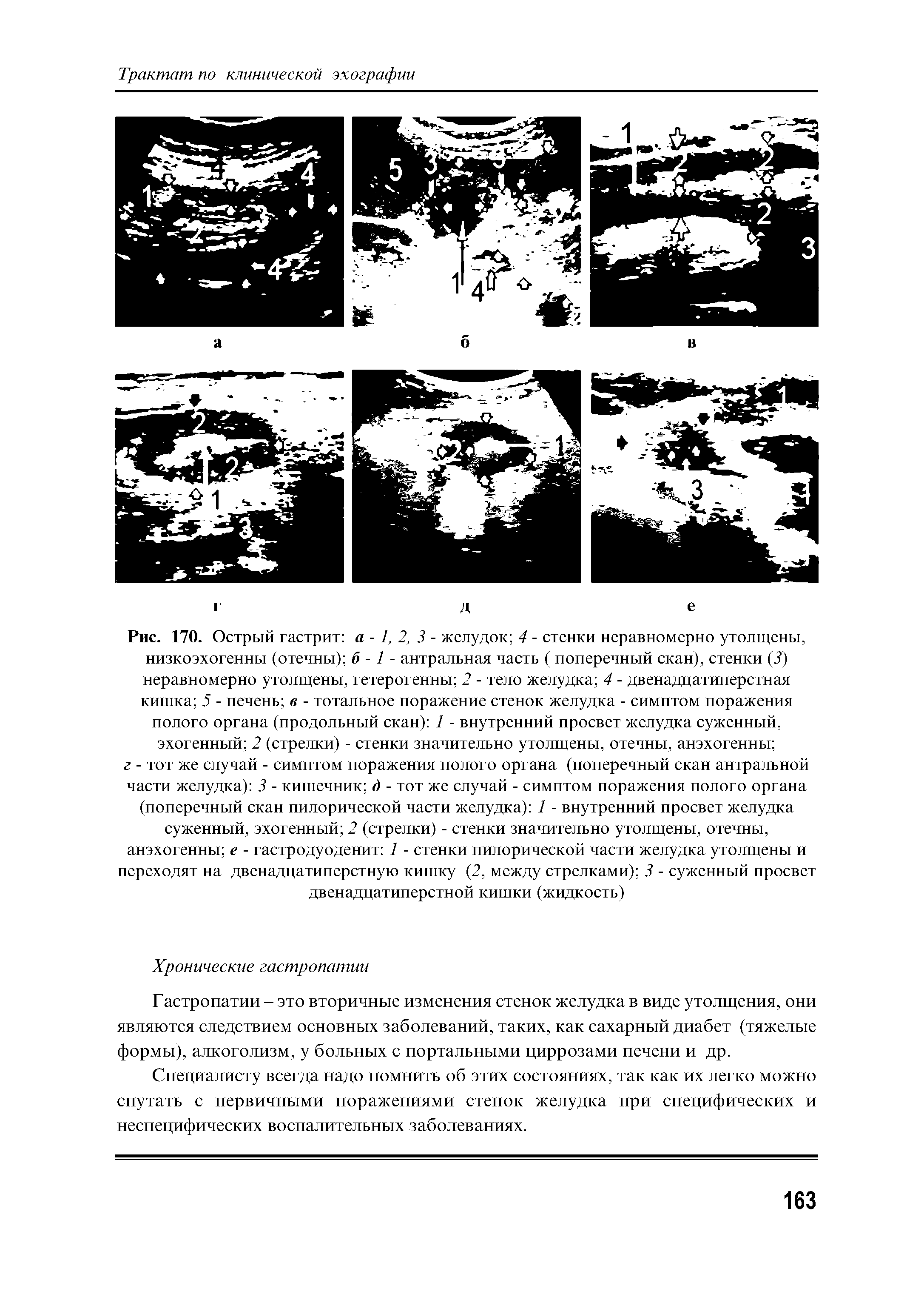 Рис. 170. Острый гастрит а -1, 2, 3 - желудок 4 - стенки неравномерно утолщены, низкоэхогенны (отечны) б -1 - антральная часть ( поперечный скан), стенки (3) неравномерно утолщены, гетерогенны 2 - тело желудка 4 - двенадцатиперстная кишка 5 - печень в - тотальное поражение стенок желудка - симптом поражения полого органа (продольный скан) 1 - внутренний просвет желудка суженный, эхогенный 2 (стрелки) - стенки значительно утолщены, отечны, анэхогенны ...