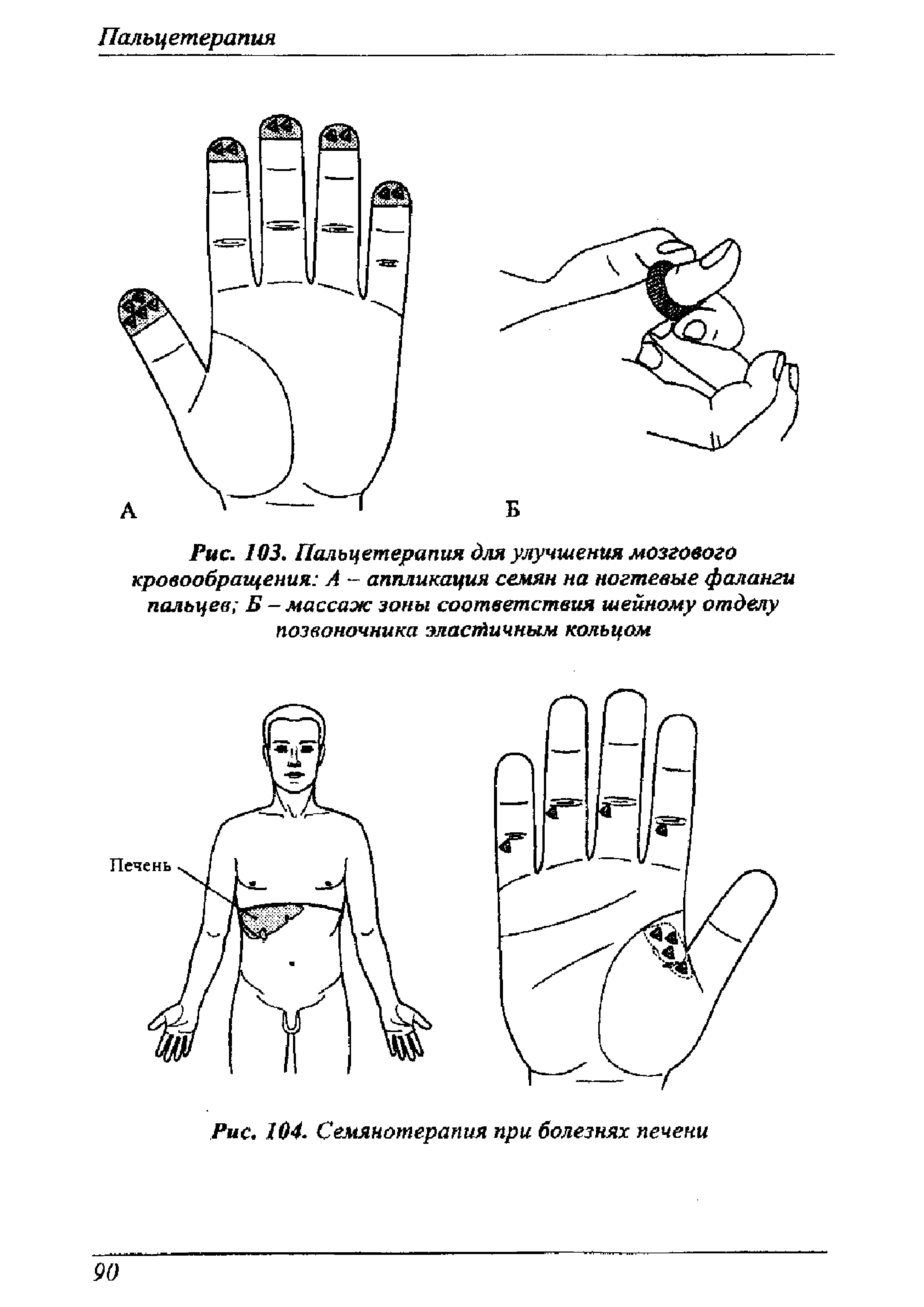 Рис. 103. Пальцетерапия для улучшения мозгового кровообращения А -- аппликация семян на ногтевые фаланги пальцев Б — массаж зоны соответствия шейному отделу позвоночника эластичным кольцом...