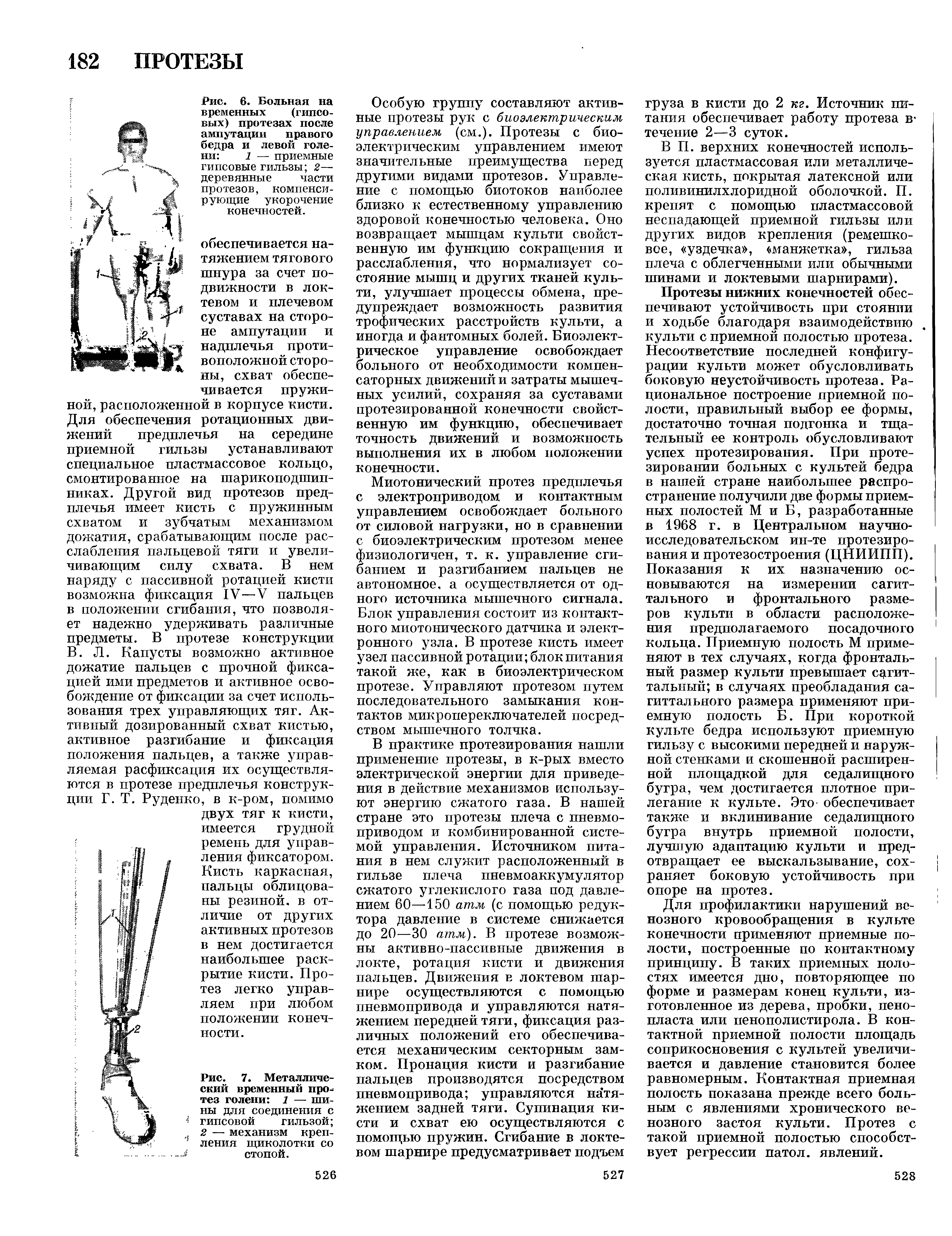 Рис. 6. Больная на временных (гипсовых) протезах после ампутации правого бедра и левой голени 1 — приемные...