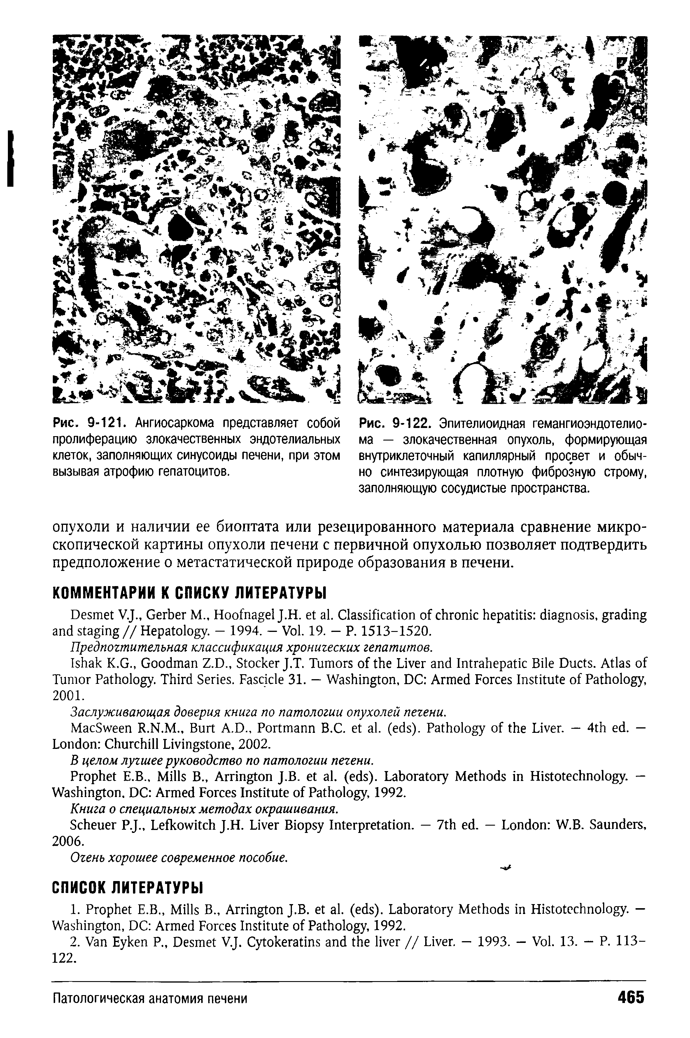 Рис. 9-122. Эпителиоидная гемангиоэндотелиома — злокачественная опухоль, формирующая внутриклеточный капиллярный просвет и обычно синтезирующая плотную фиброзную строму, заполняющую сосудистые пространства.