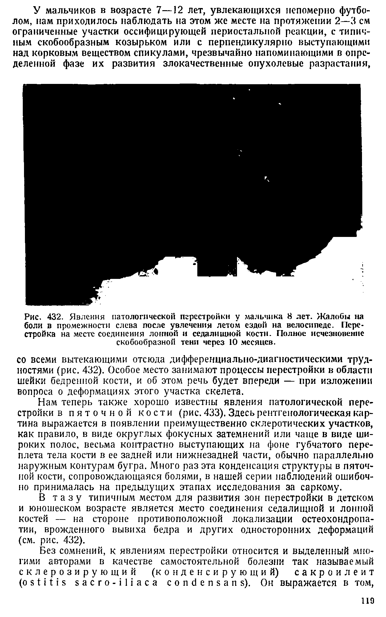 Рис. 432. Явления патологической перестройки у мальчика 8 лет. Жалобы па боли в промежности слева после увлечения летом ездой на велосипеде. Перестройка на месте соединения лонной и седалищной кости. Полное исчезновение скобообразной тени через 10 месяцев.