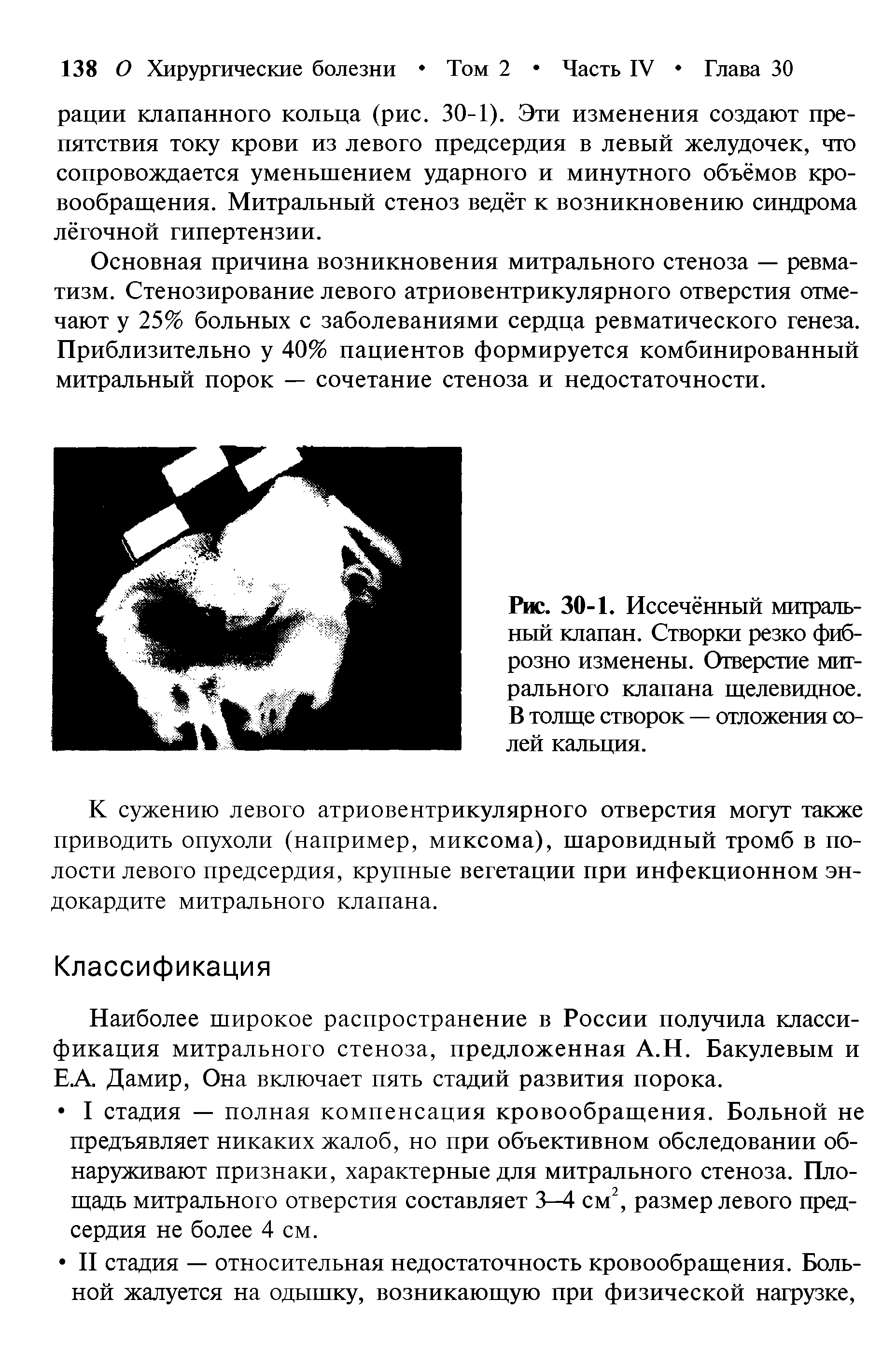 Рис. 30-1. Иссечённый митральный клапан. Створки резко фиб-розно изменены. Отверстие митрального клапана щелевидное. В толще створок — отложения солей кальция.