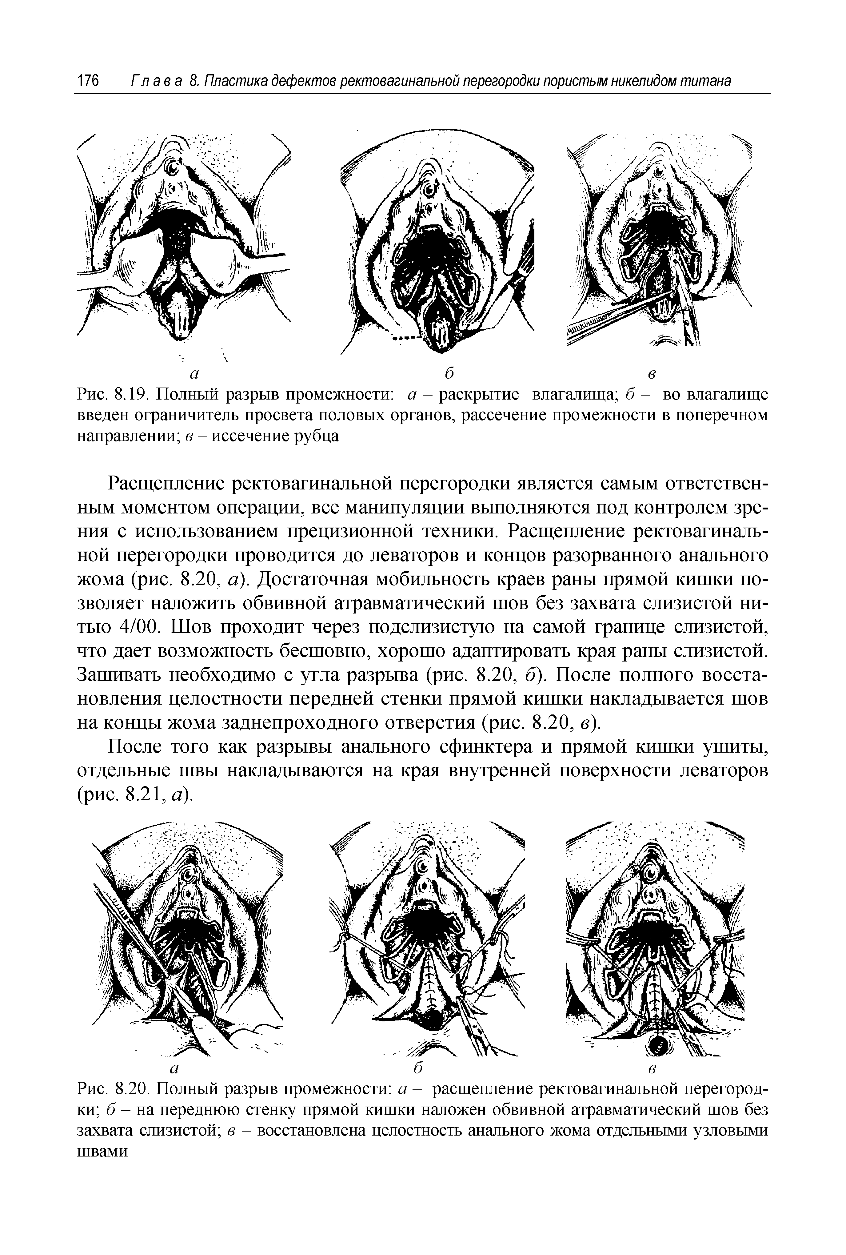 Рис. 8.20. Полный разрыв промежности а - расщепление ректовагинальной перегородки б - на переднюю стенку прямой кишки наложен обвивной атравматический шов без захвата слизистой в - восстановлена целостность анального жома отдельными узловыми швами...