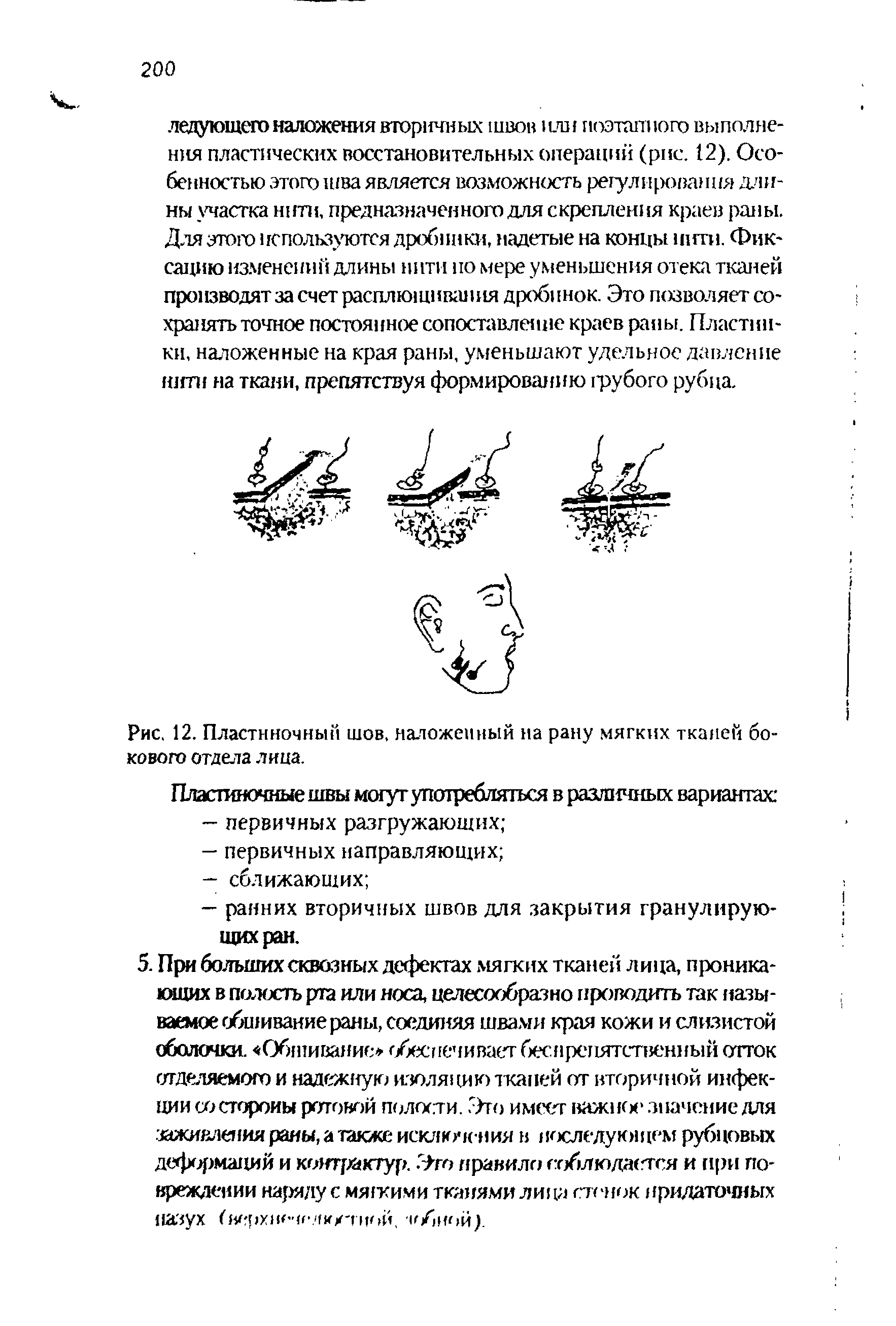 Рис. 12. Пластиночным шов, наложенный на рану мягких тканей бокового отдела лица.