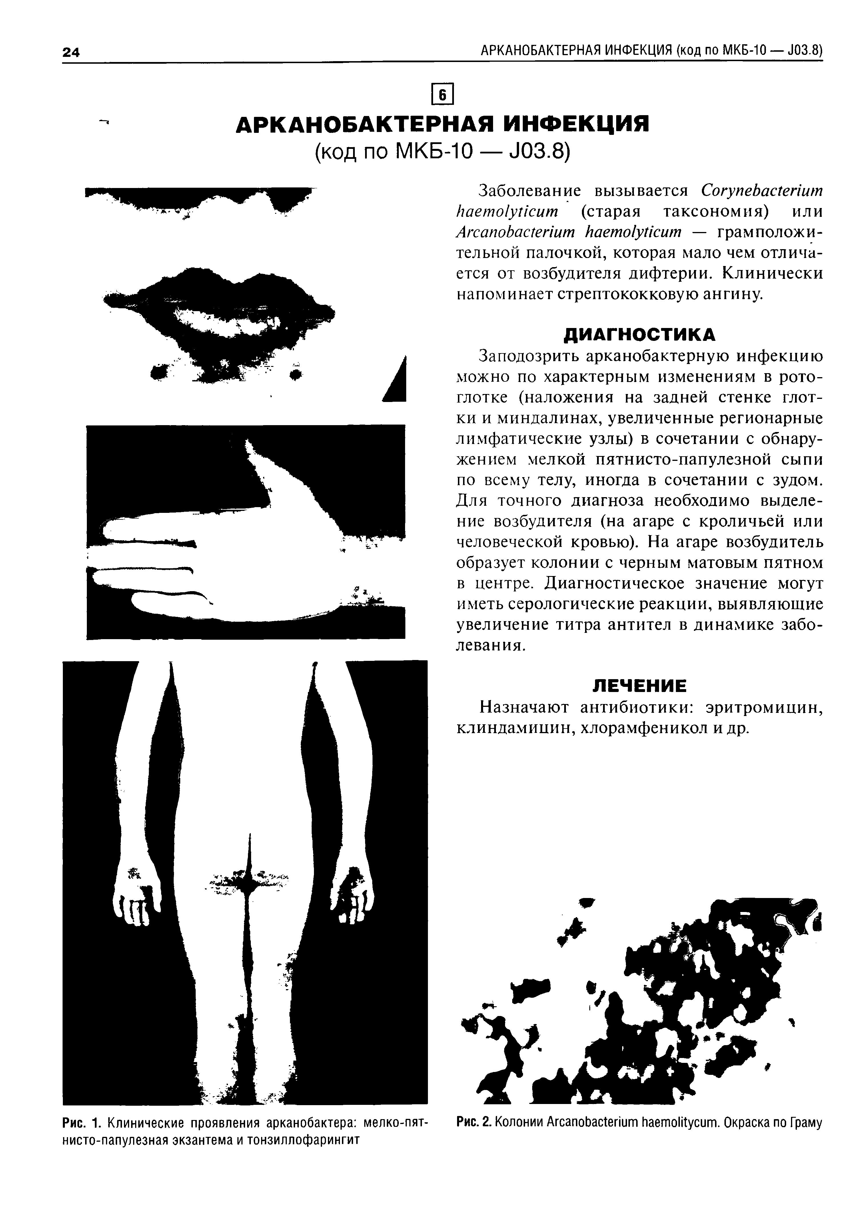 Рис. 1. Клинические проявления арканобактера мелко-пят-нисто-папулезная экзантема и тонзиллофарингит...