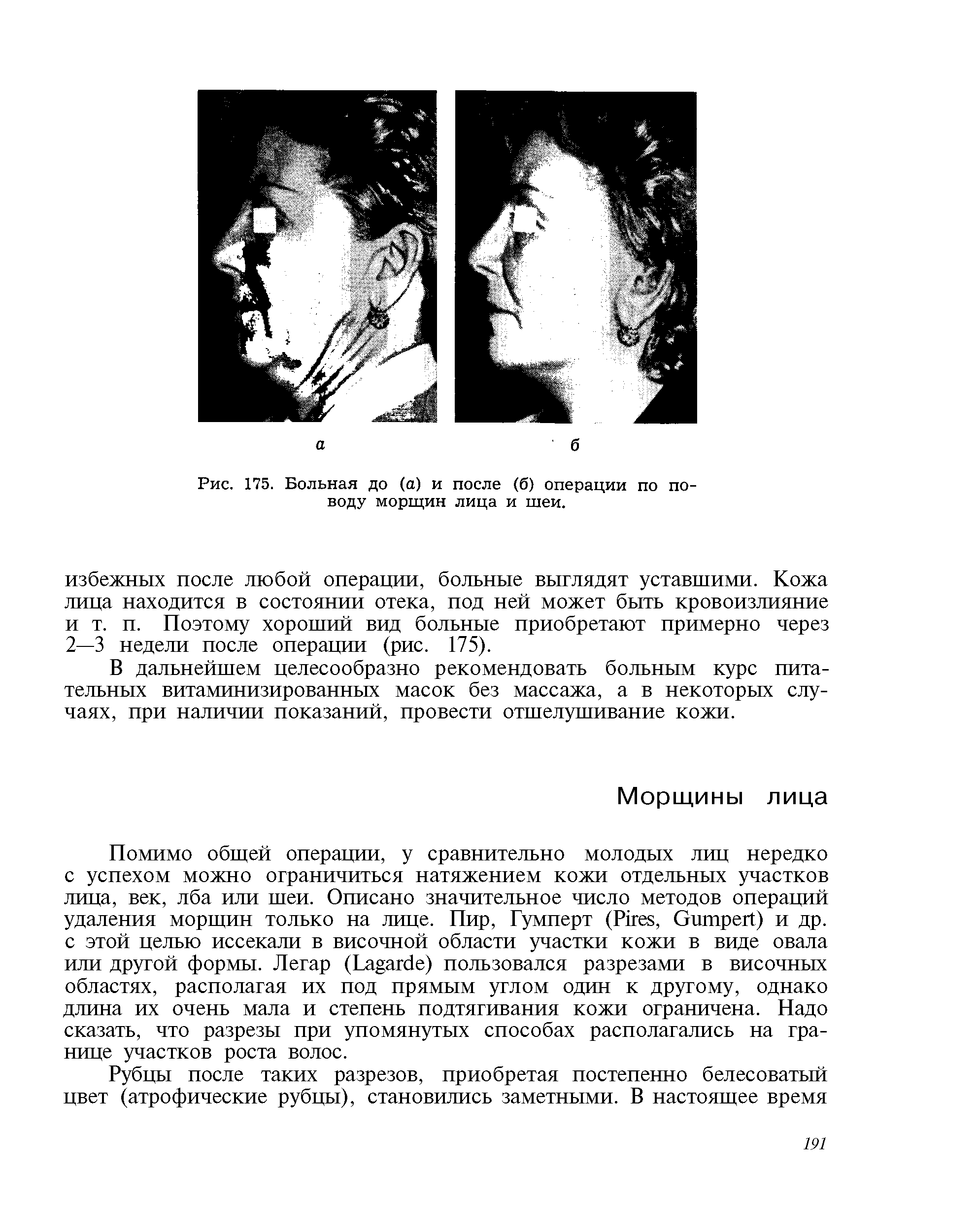 Рис. 175. Больная до (а) и после (б) операции по поводу морщин лица и шеи.