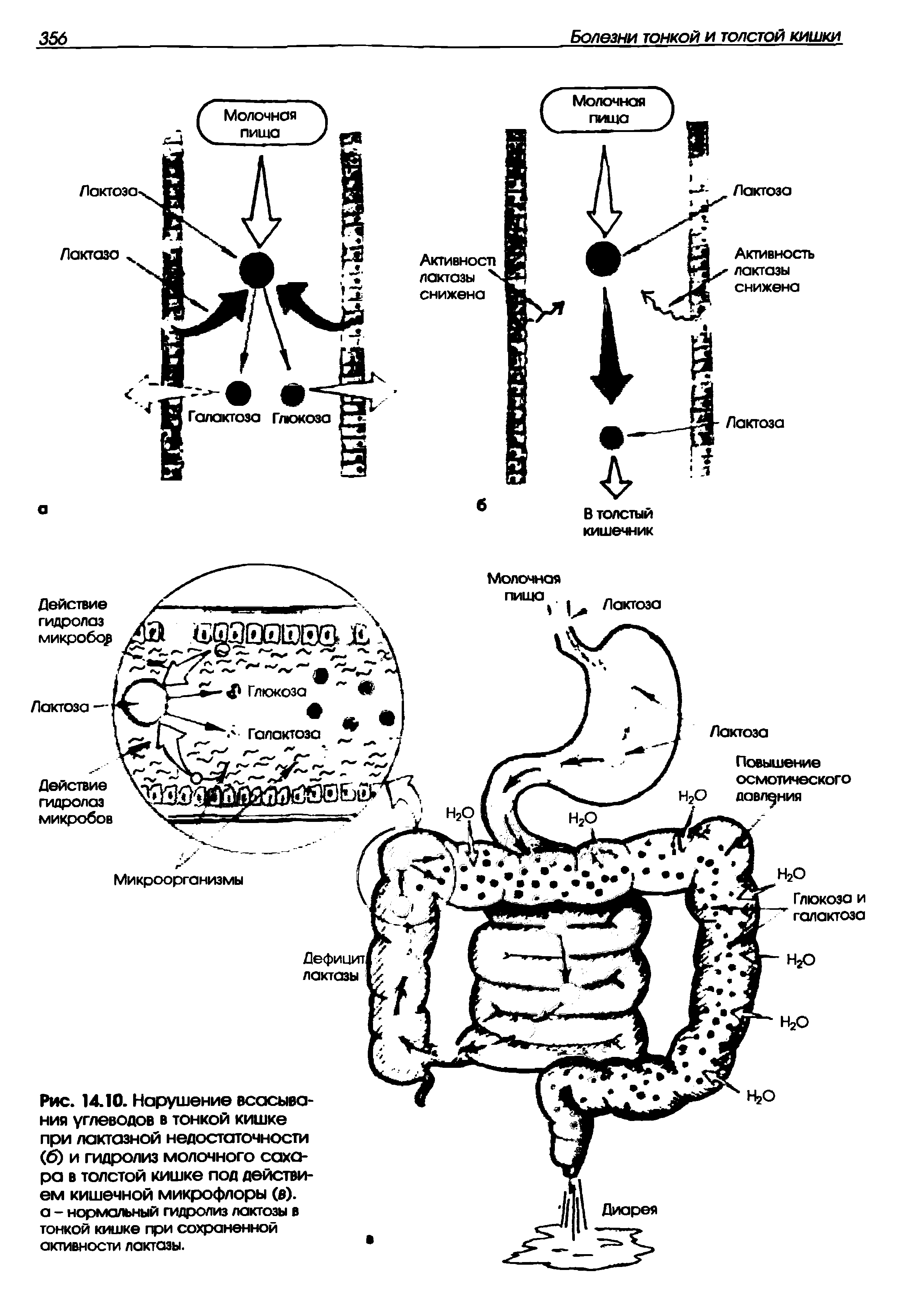Рис. 14.10. Нарушение всасывания углеводов в тонкой кишке при лактазной недостаточности (6) и гидролиз молочного сахара в толстой кишке под действием кишечной микрофлоры (в), а - нормальный гидролиз лактозы в тонкой кишке при сохраненной активности лактазы.