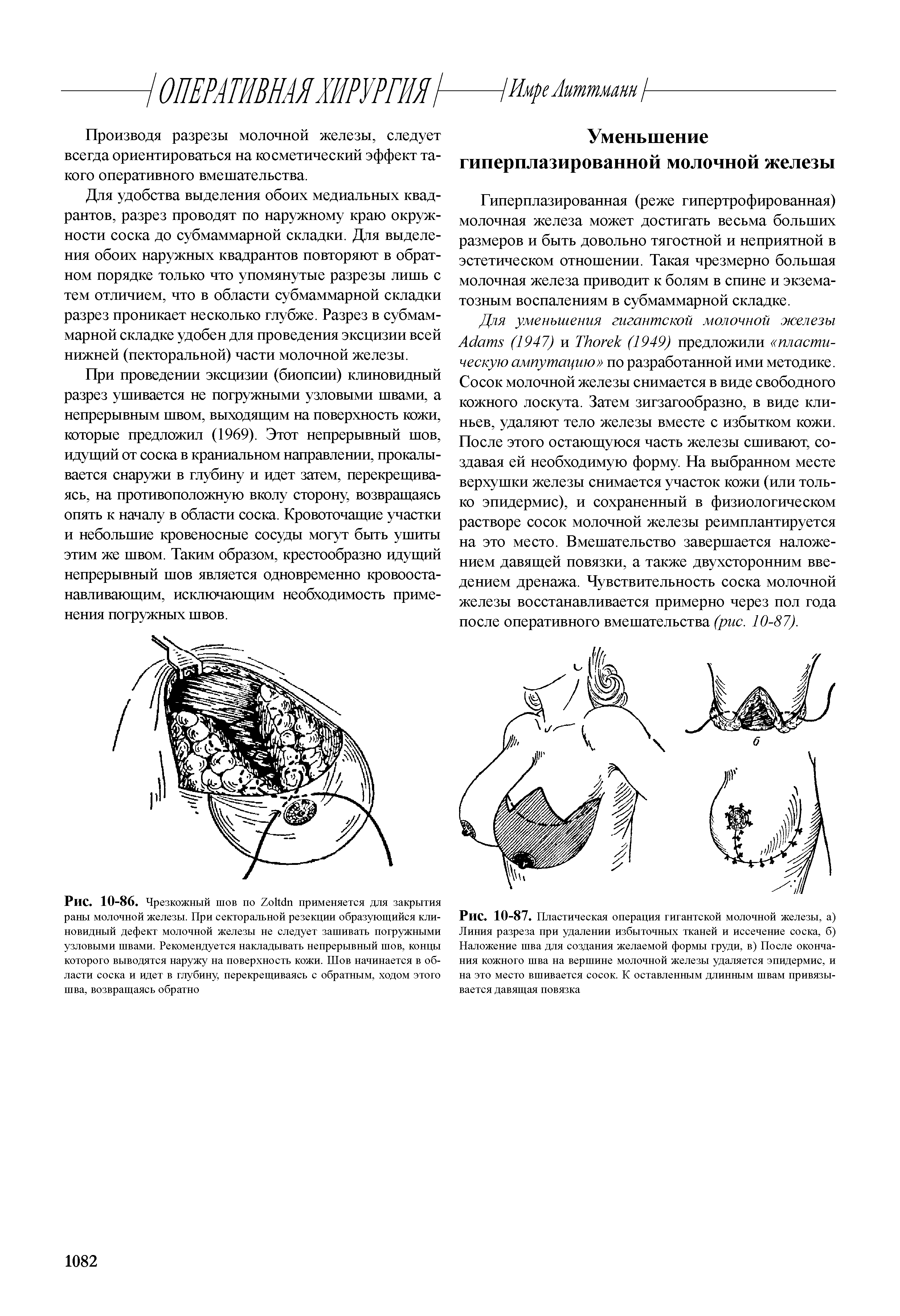 Рис. 10-87. Пластическая операция гигантской молочной железы, а) Линия разреза при удалении избыточных тканей и иссечение соска, б) Наложение шва для создания желаемой формы груди, в) После окончания кожного шва на вершине молочной железы удаляется эпидермис, и на это место вшивается сосок. К оставленным длинным швам привязывается давящая повязка...