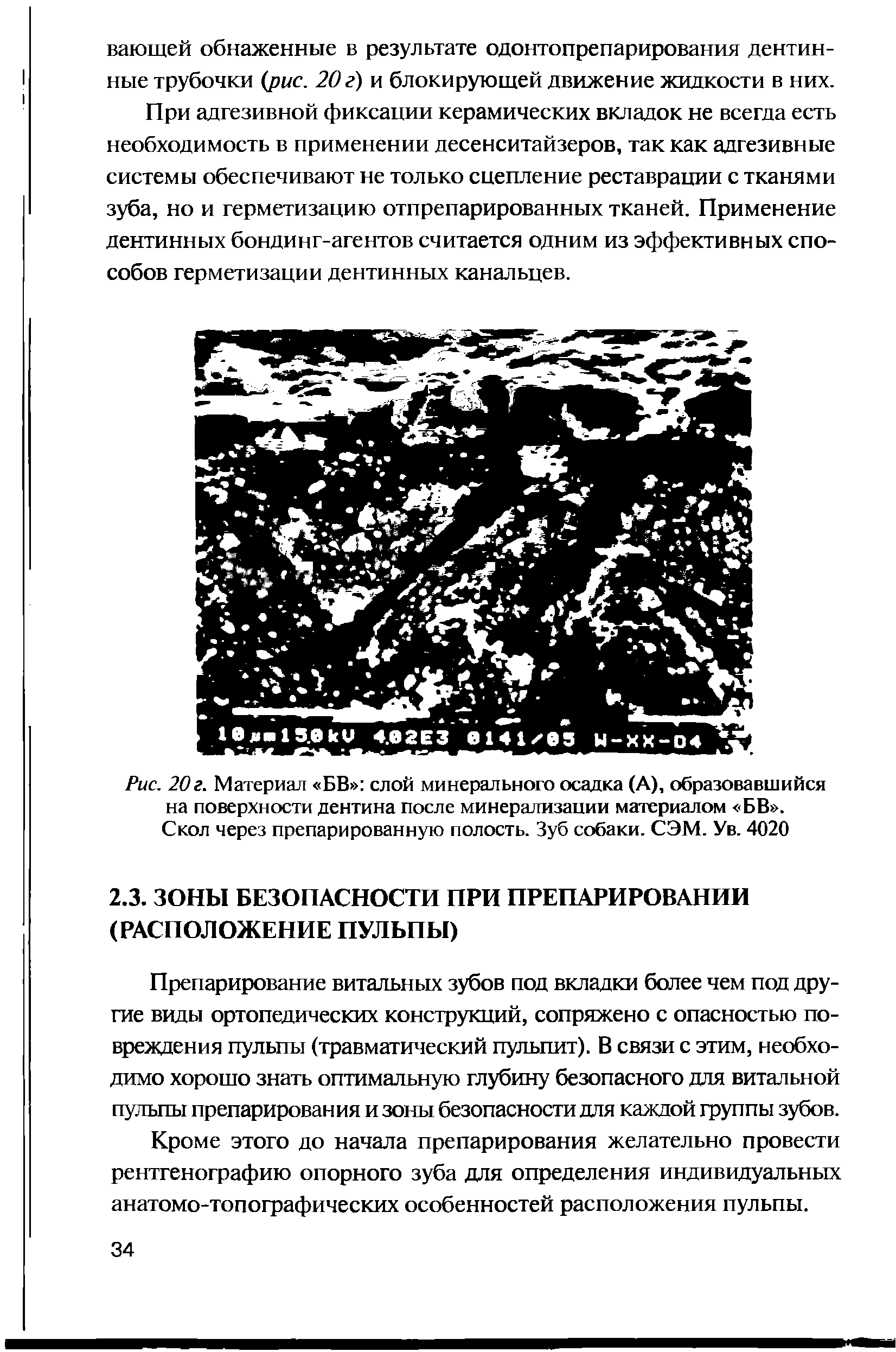 Рис. 20г. Материал БВ слой минерального осадка (А), образовавшийся на поверхности дентина после минерализации материалом БВ . Скол через препарированную полость. Зуб собаки. СЭМ. Ув. 4020...