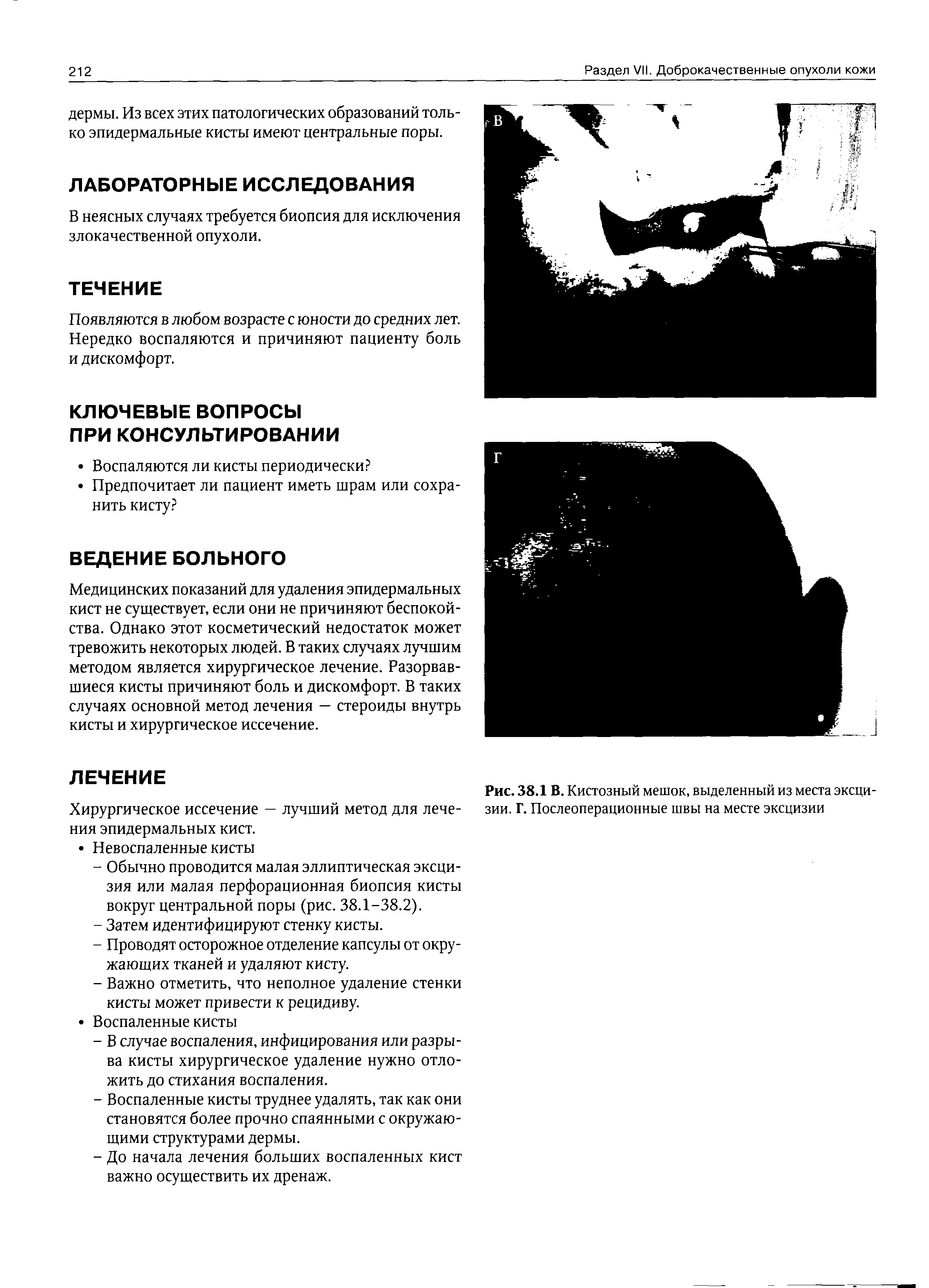 Рис. 38.1 В. Кистозный мешок, выделенный из места эксци-зии. Г. Послеоперационные швы на месте эксцизии...