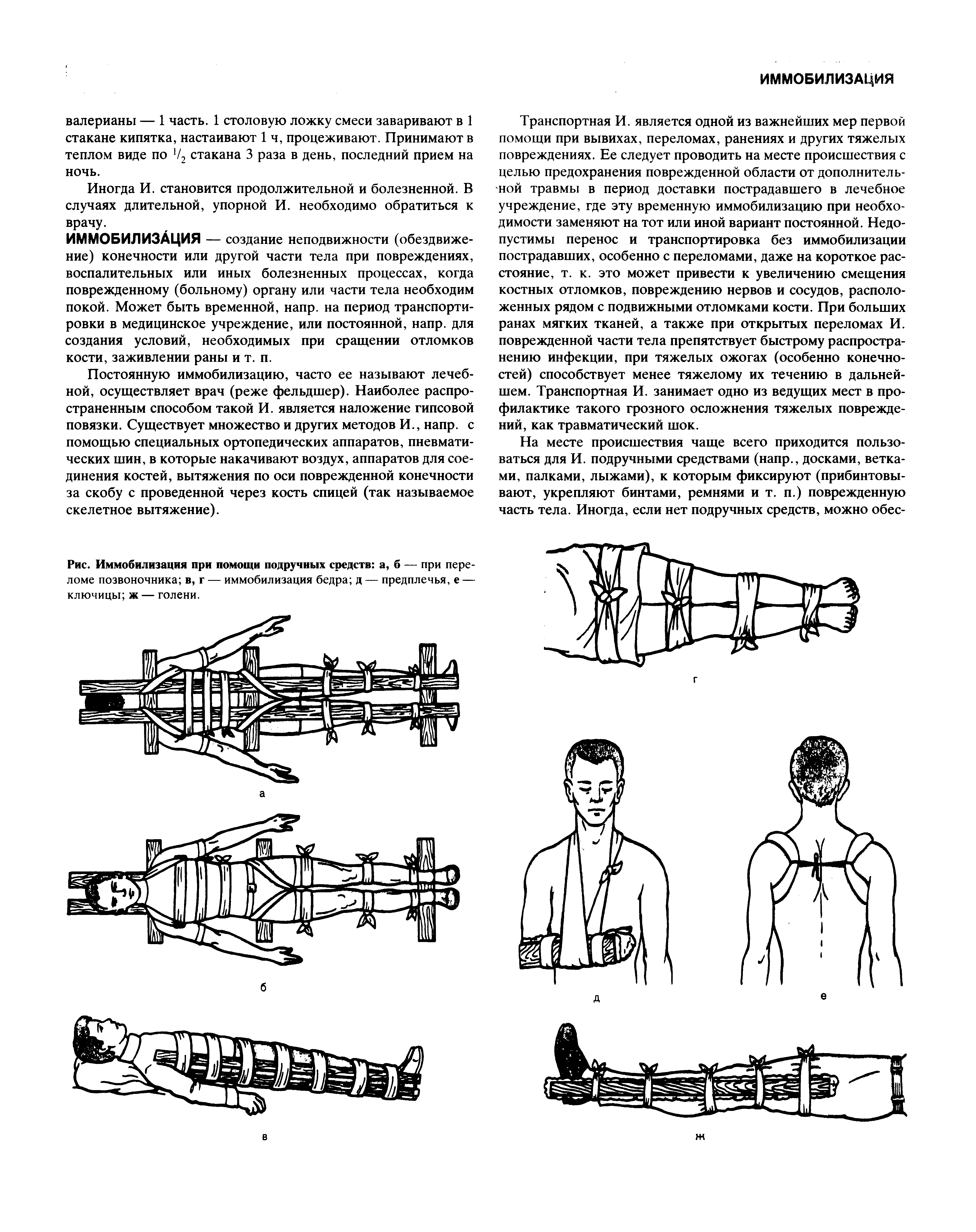 Рис. Иммобилизация при помощи подручных средств а, б — при переломе позвоночника в, г — иммобилизация бедра д — предплечья, е — ключицы ж — голени.