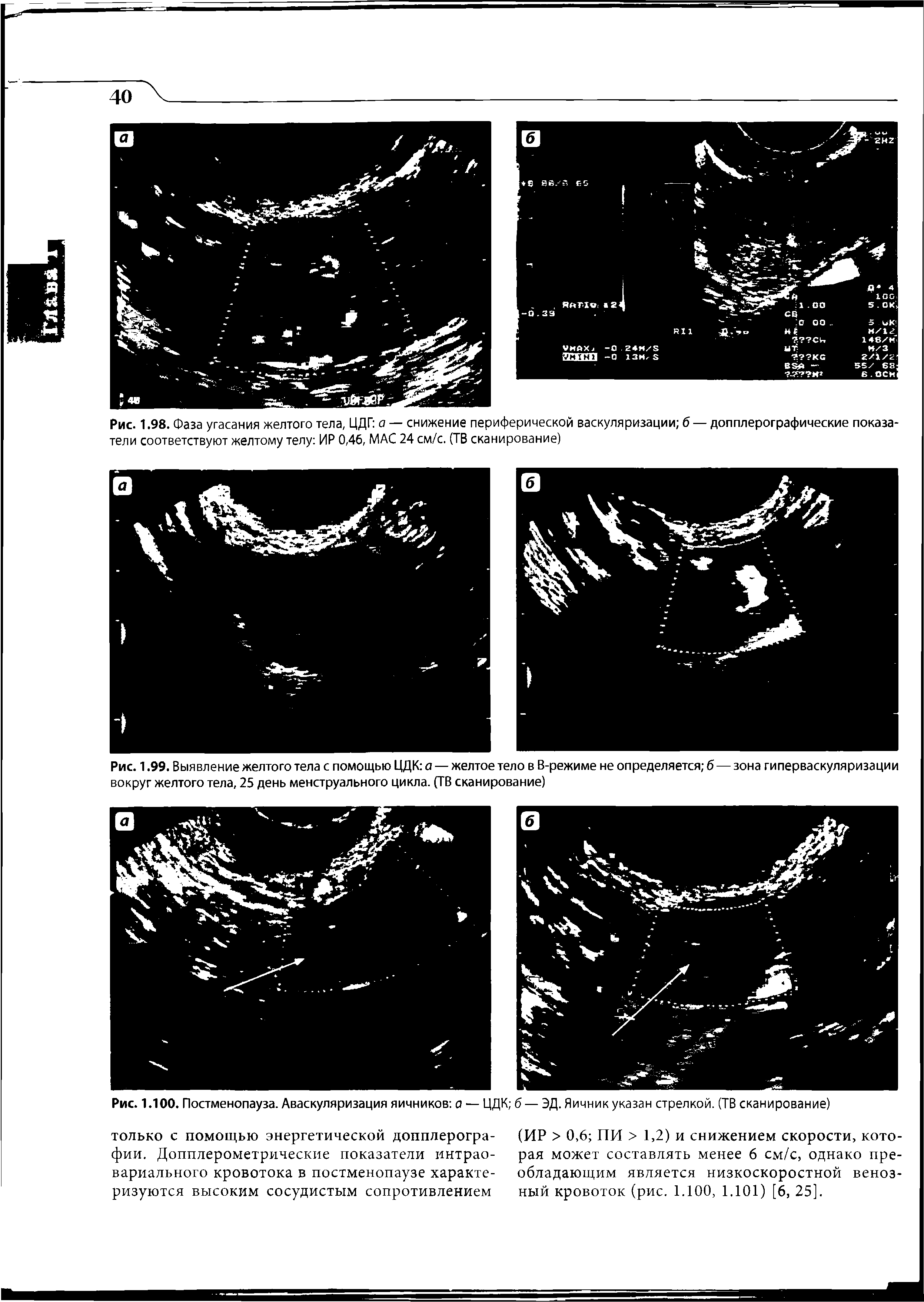 Рис. 1.99. Выявление желтого тела с помощью ЦДК а — желтое тело в В-режиме не определяется б — зона гиперваскуляризации вокруг желтого тела, 25 день менструального цикла. (ТВ сканирование)...
