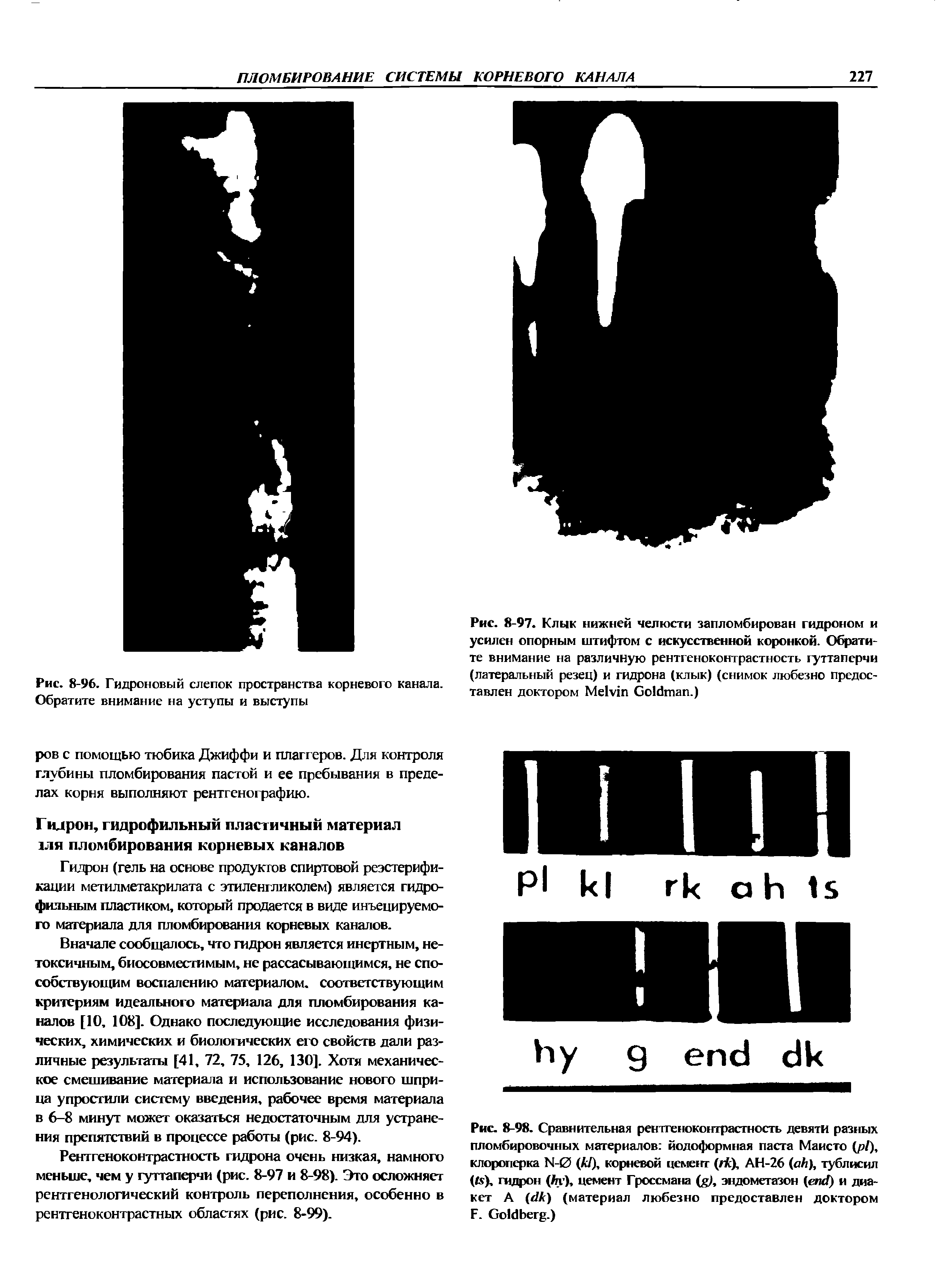 Рис. 8-97. Клык нижней челюсти запломбирован гидроном и усилен опорным штифтом с искусственной коронкой. Обратите внимание на различную рентгеноконтрастность гуттаперчи (латеральный резец) и гидрона (клык) (снимок любезно предоставлен доктором M G .)...