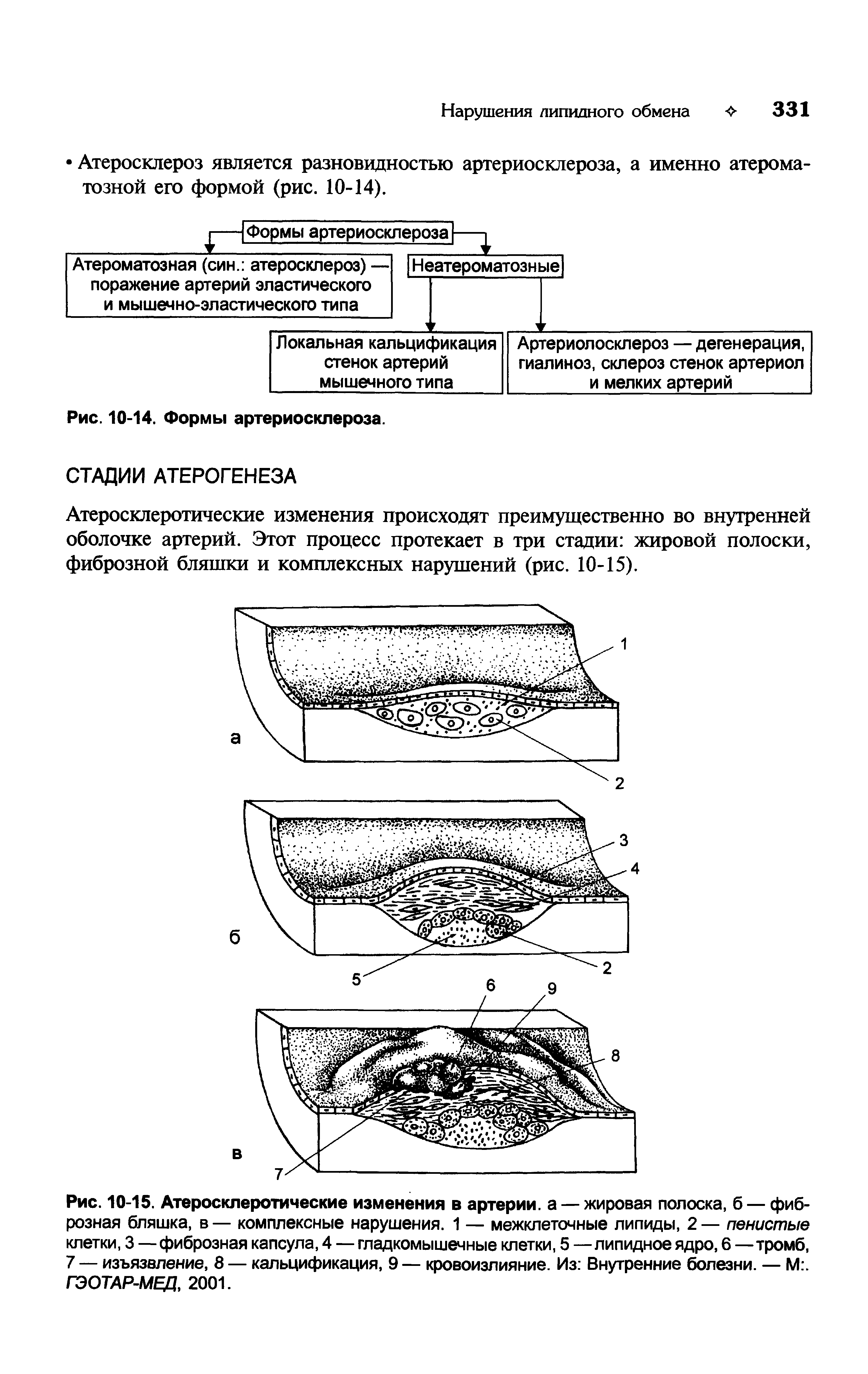 Рис. 10-15. Атеросклеротические изменения в артерии, а — жировая полоска, б — фиброзная бляшка, в — комплексные нарушения. 1 — межклеточные липиды, 2 — пенистые клетки, 3 — фиброзная капсула, 4 — гладкомышечные клетки, 5 —липидное ядро, 6 —тромб, 7 — изъязвление, 8 — кальцификация, 9— кровоизлияние. Из Внутренние болезни. — М . ГЭОТАР-МЕД, 2001.