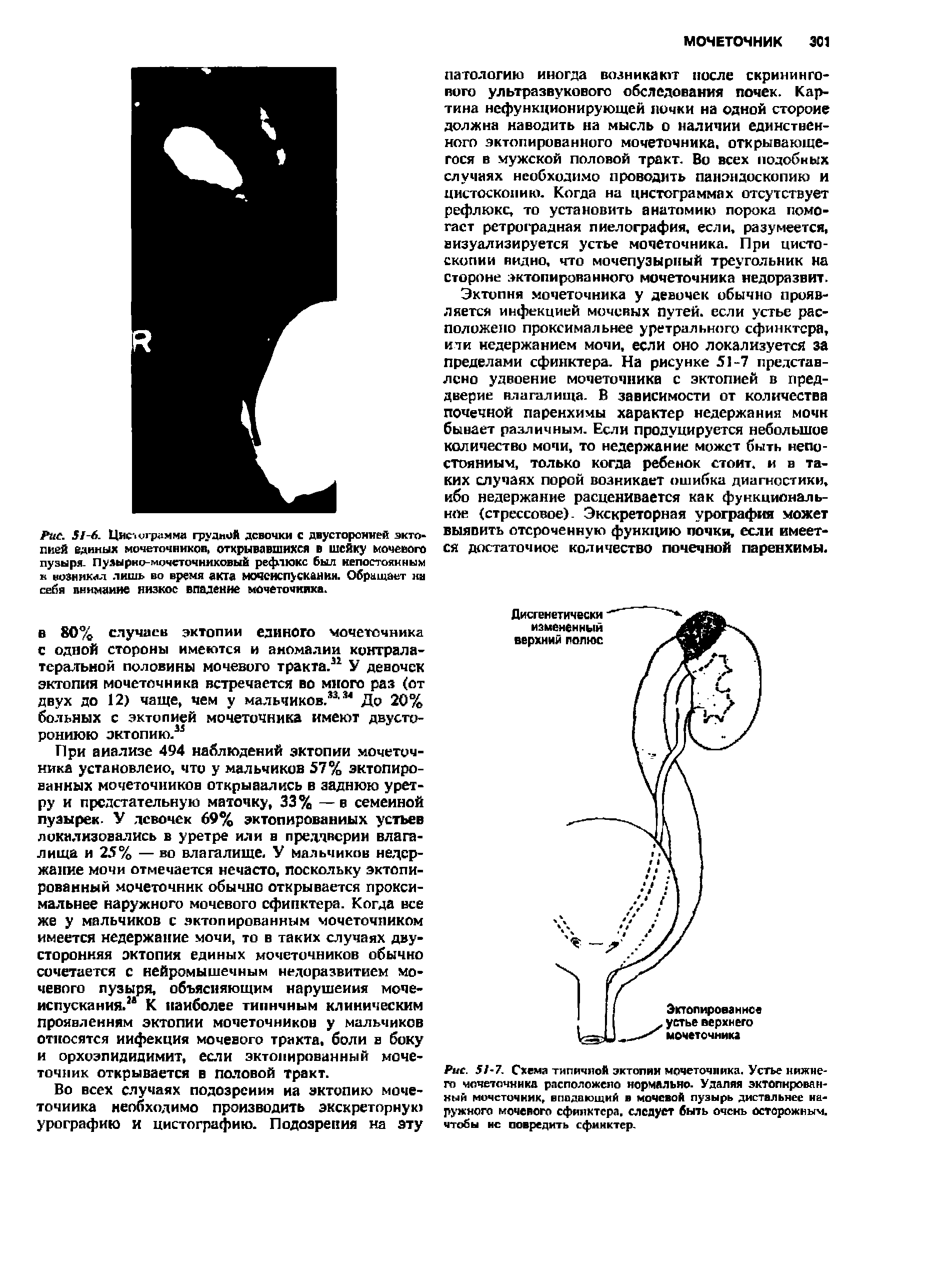 Рис. 51-7. Схема типичной эктопия мочеточника. Устье нижнего мочеточника расположено нормально. Удаляя эктопированный мочеточник, впадающий в мочевой пузырь дистальнее наружного мочевого сфинктера, следует быть очень осторожным, чтобы вс повредить сфинктер.