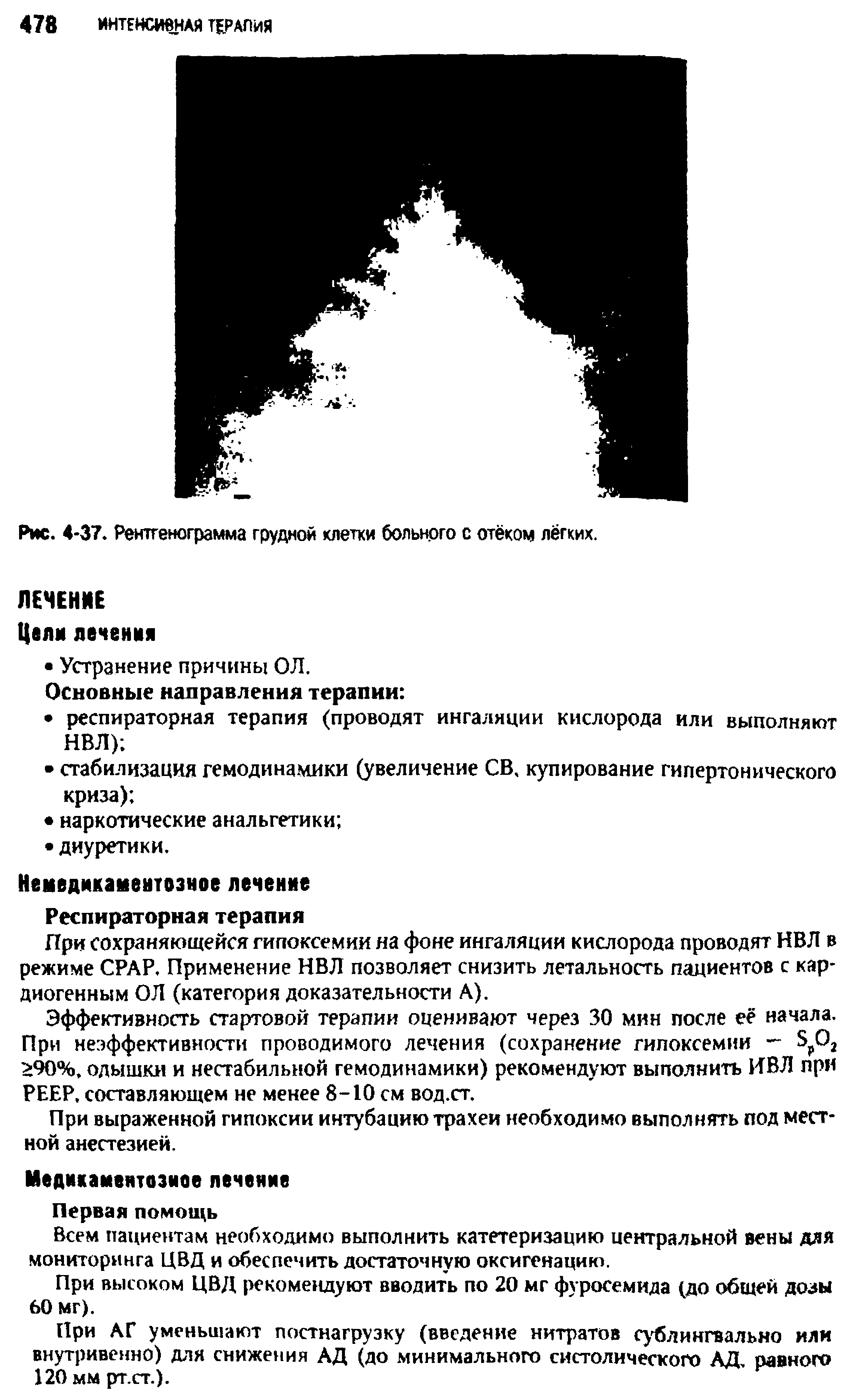 Рис. 4-37. Рентгенограмма грудной клетки больного с отёком лёгких.