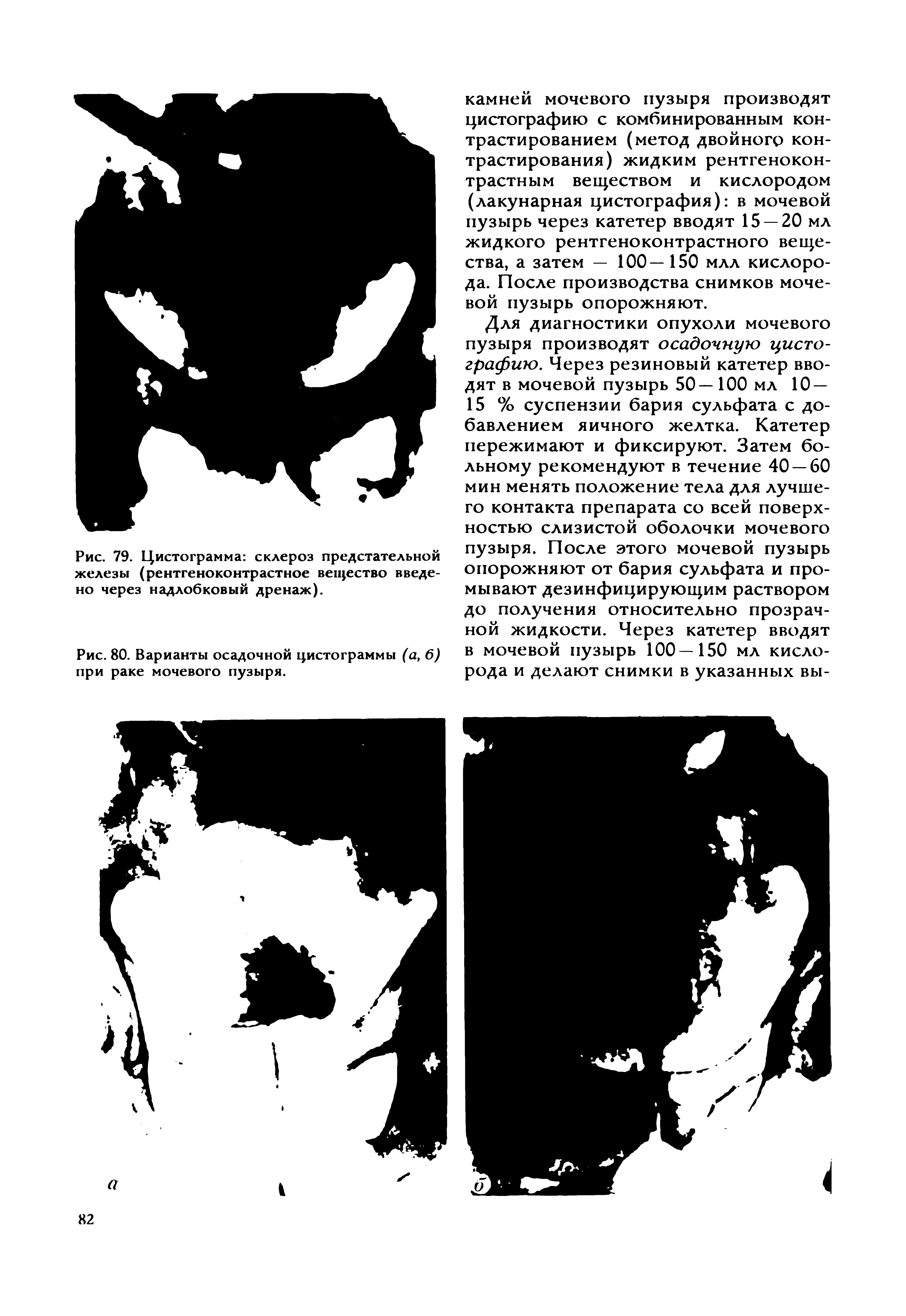 Рис. 80. Варианты осадочной цистограммы (а, 6) при раке мочевого пузыря.