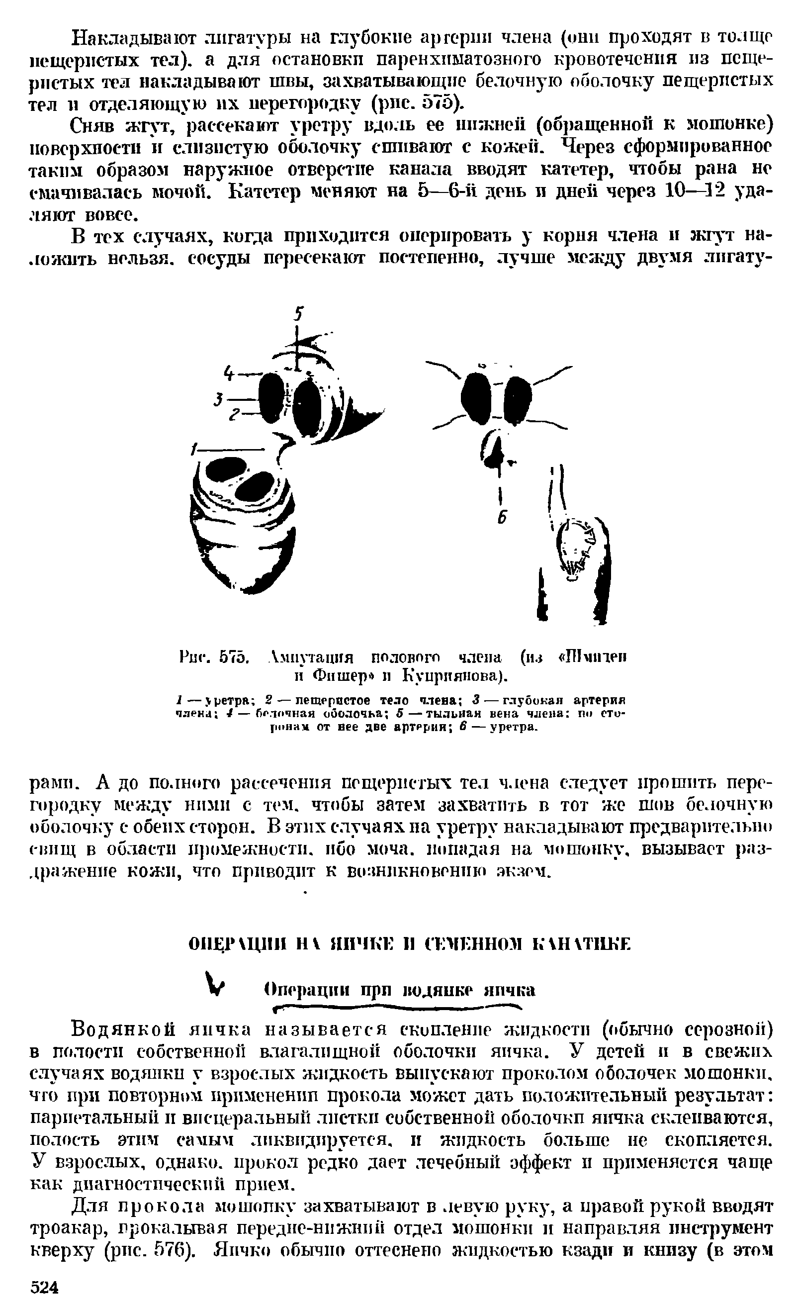 Рис. 575. Ампутация полового члена (из ПКипеп и Фишер и Куприянова).