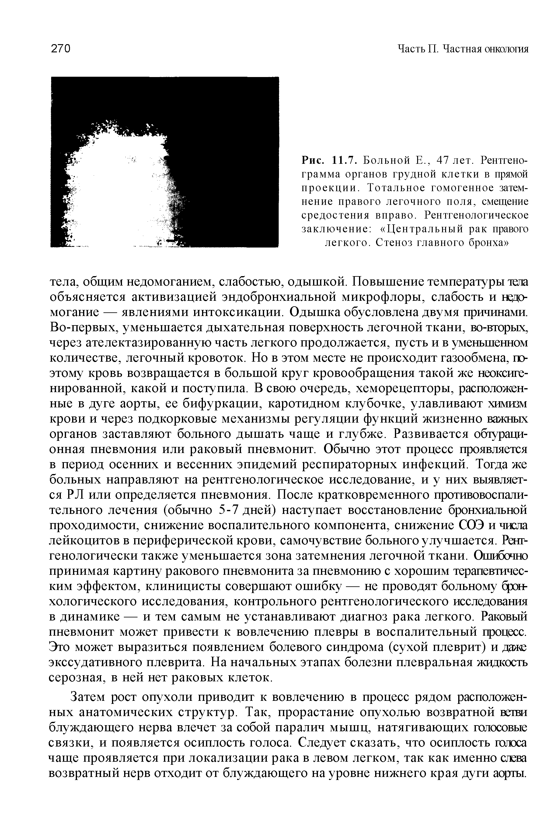 Рис. 11.7. Б ольной Е., 47 лет. Рентгенограмма органов грудной клетки в прямой проекции. Тотальное гомогенное затемнение правого легочного поля, смещение средостения вправо. Рентгенологическое заключение Центральный рак правого легкого. Стеноз главного бронха ...