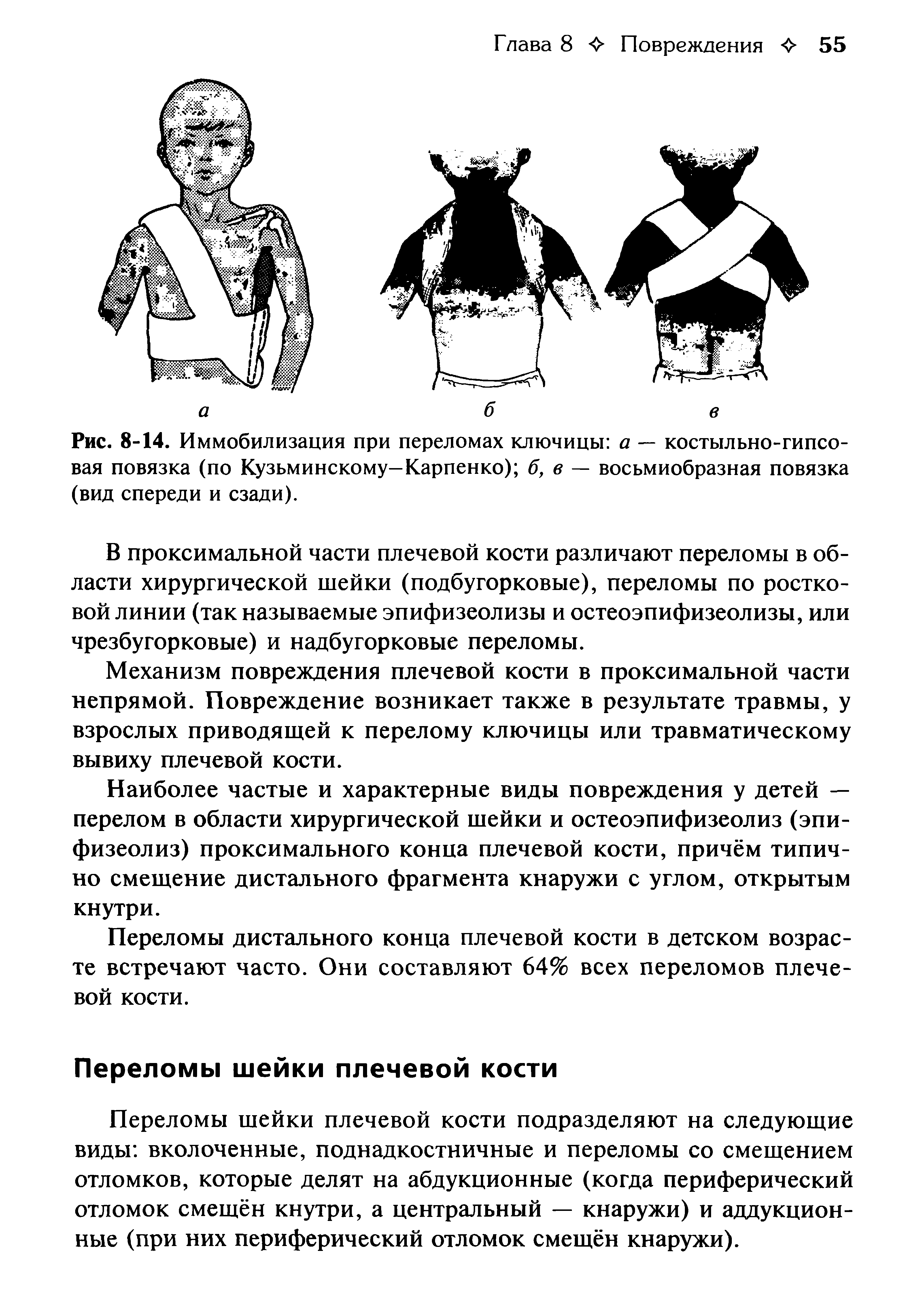 Рис. 8-14. Иммобилизация при переломах ключицы а — костыльно-гипсовая повязка (по Кузьминскому—Карпенко) б, в — восьмиобразная повязка (вид спереди и сзади).