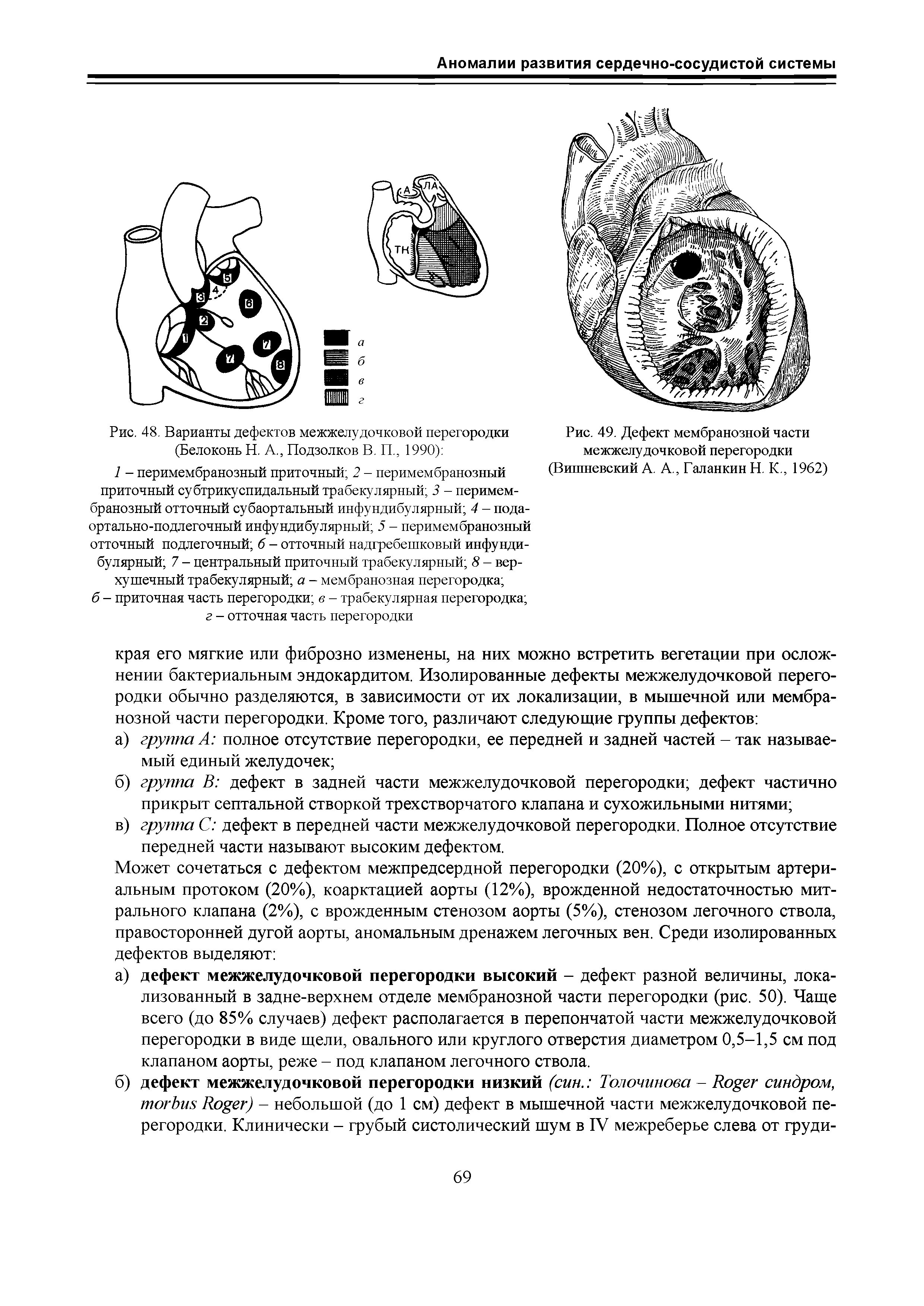 Рис. 49. Дефект мембранозной части межжелудочковой перегородки (Вишневский А. А., Таланкин Н. К., 1962)...