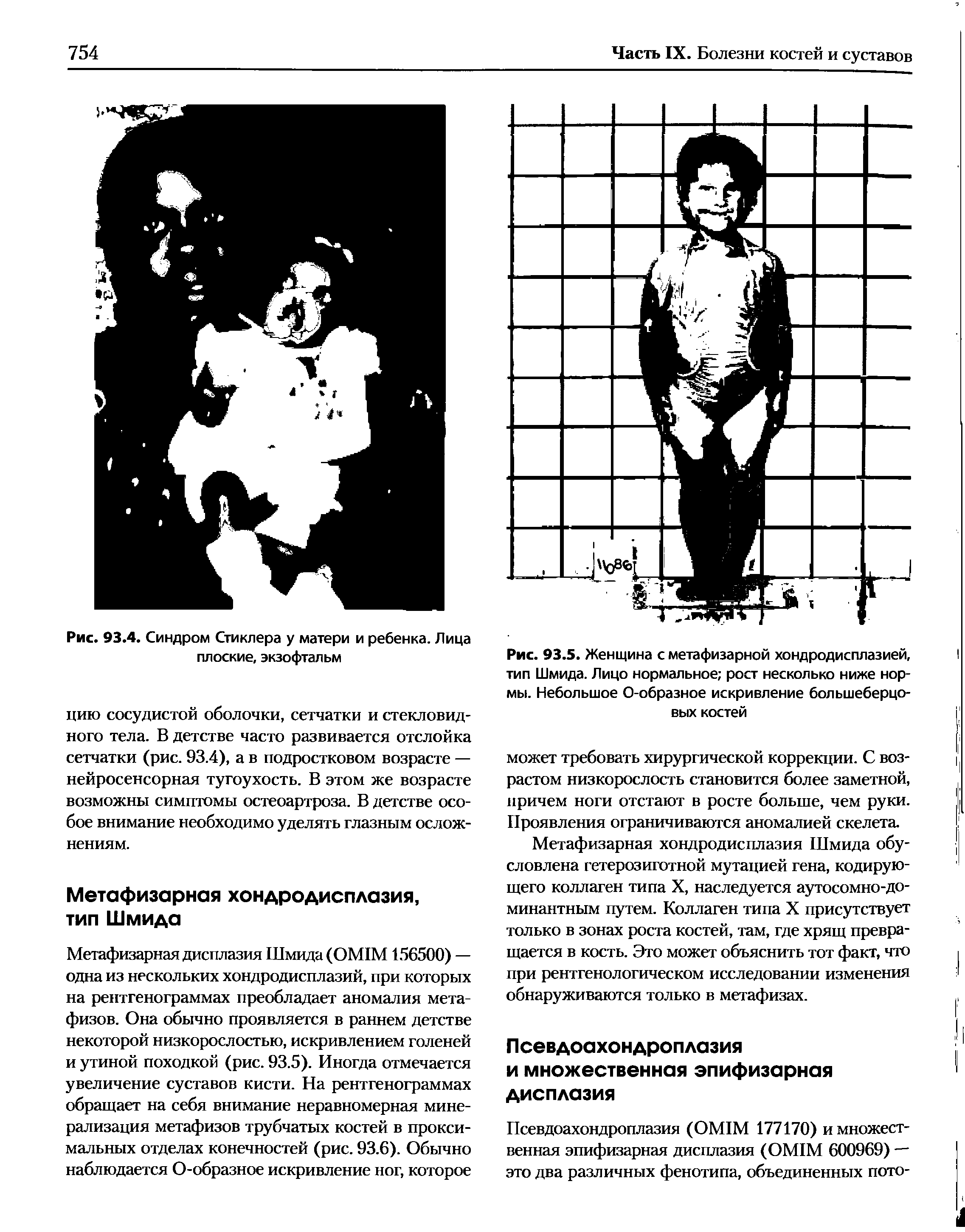 Рис. 93.5. Женщина с метафизарной хондродисплазией, тип Шмида. Лицо нормальное рост несколько ниже нормы. Небольшое О-образное искривление большеберцовых костей...