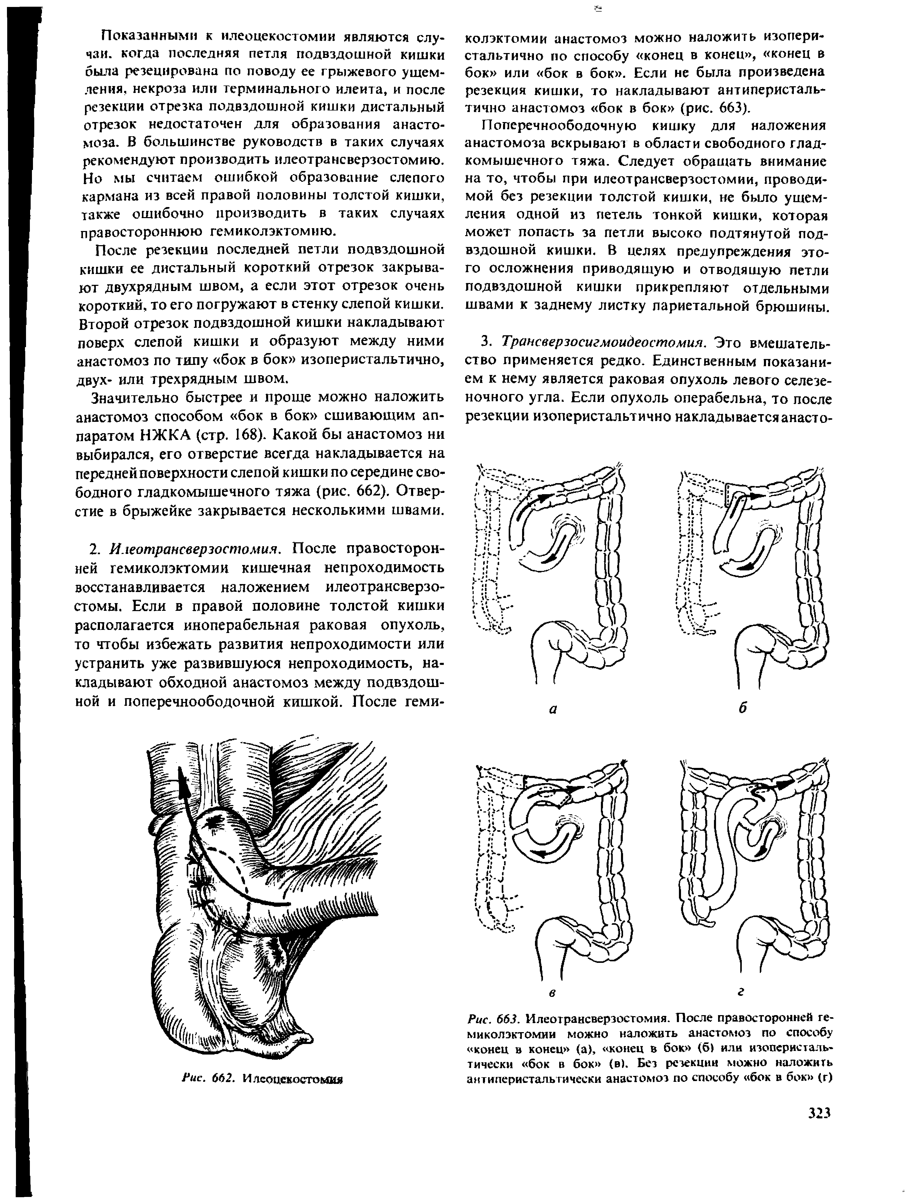 Рис. 663. Илеотрансверзостомия. После правосторонней геми колэктомии можно наложить анастомоз по способу конец в конец (а), конец в бок (61 или изоперистальтически бок в бок (в). Без резекции можно наложить антиперистальтически анастомоз по способу бок в бок (г)...
