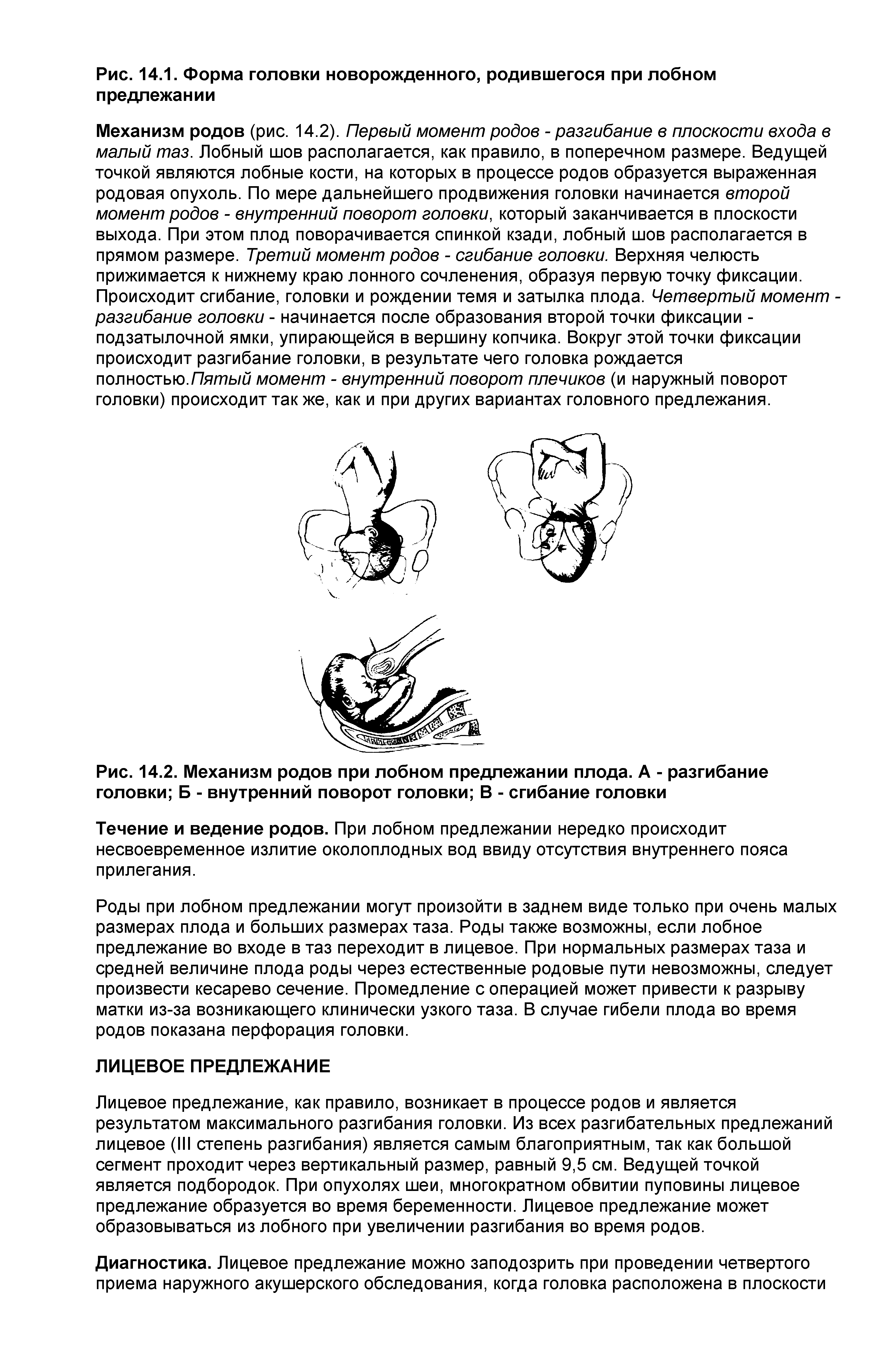 Рис. 14.2. Механизм родов при лобном предлежании плода. А - разгибание головки Б - внутренний поворот головки В - сгибание головки...