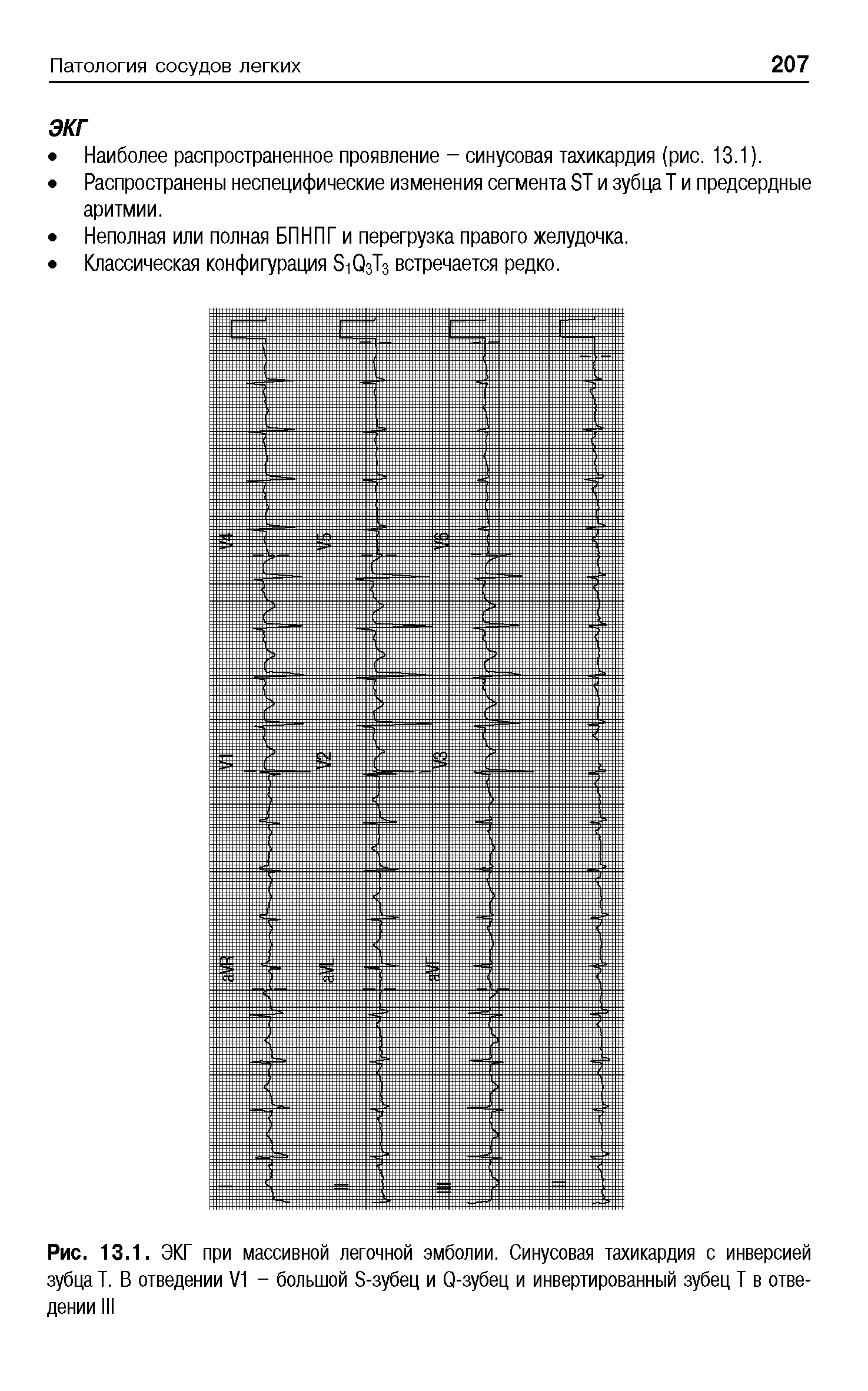 Рис. 13.1. ЭКГ при массивной легочной эмболии. Синусовая тахикардия с инверсией зубца Т. В отведении V1 - большой S-зубец и Q-зубец и инвертированный зубец Т в отведении III...